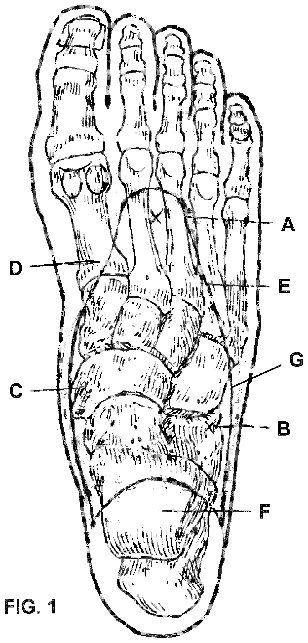 Orthopedic shoe appliance