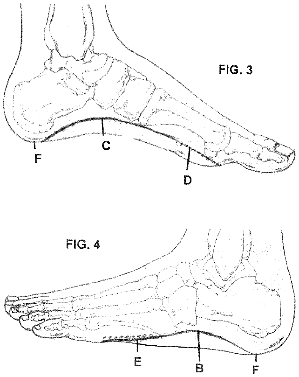 Orthopedic shoe appliance