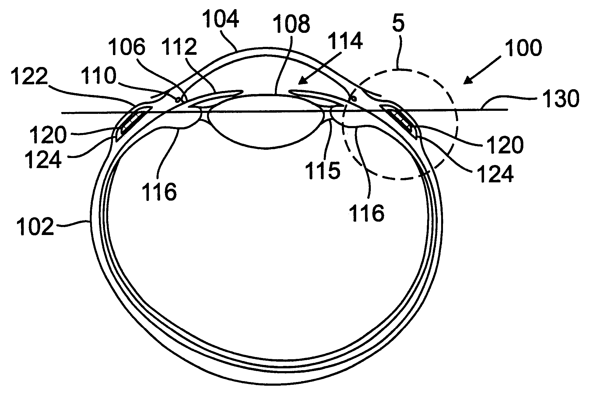 Scleral prosthesis for treatment of presbyopia and other eye disorders