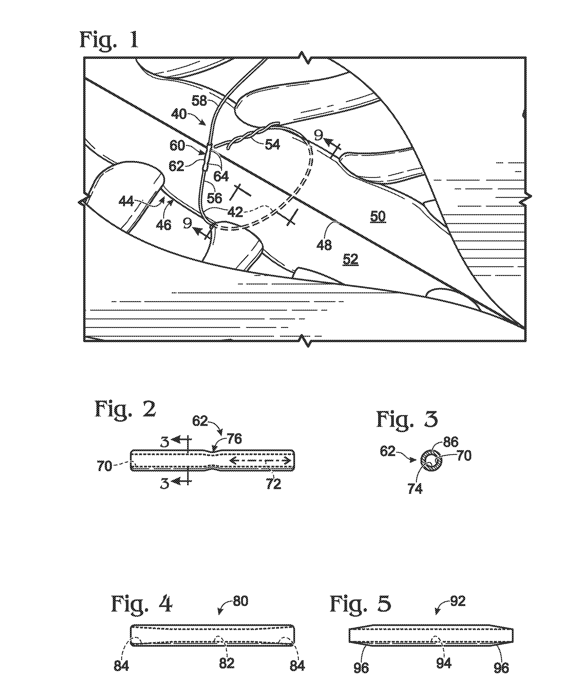 Replacement system for a surgical wire