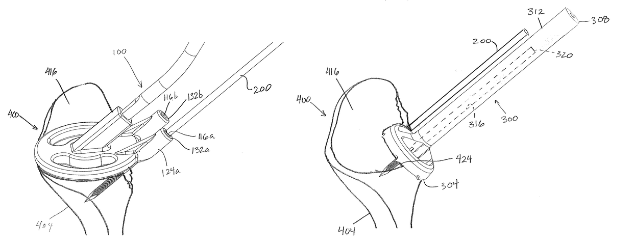 Devices, apparatuses, kits, and methods for repair of articular surface and/or articular rim