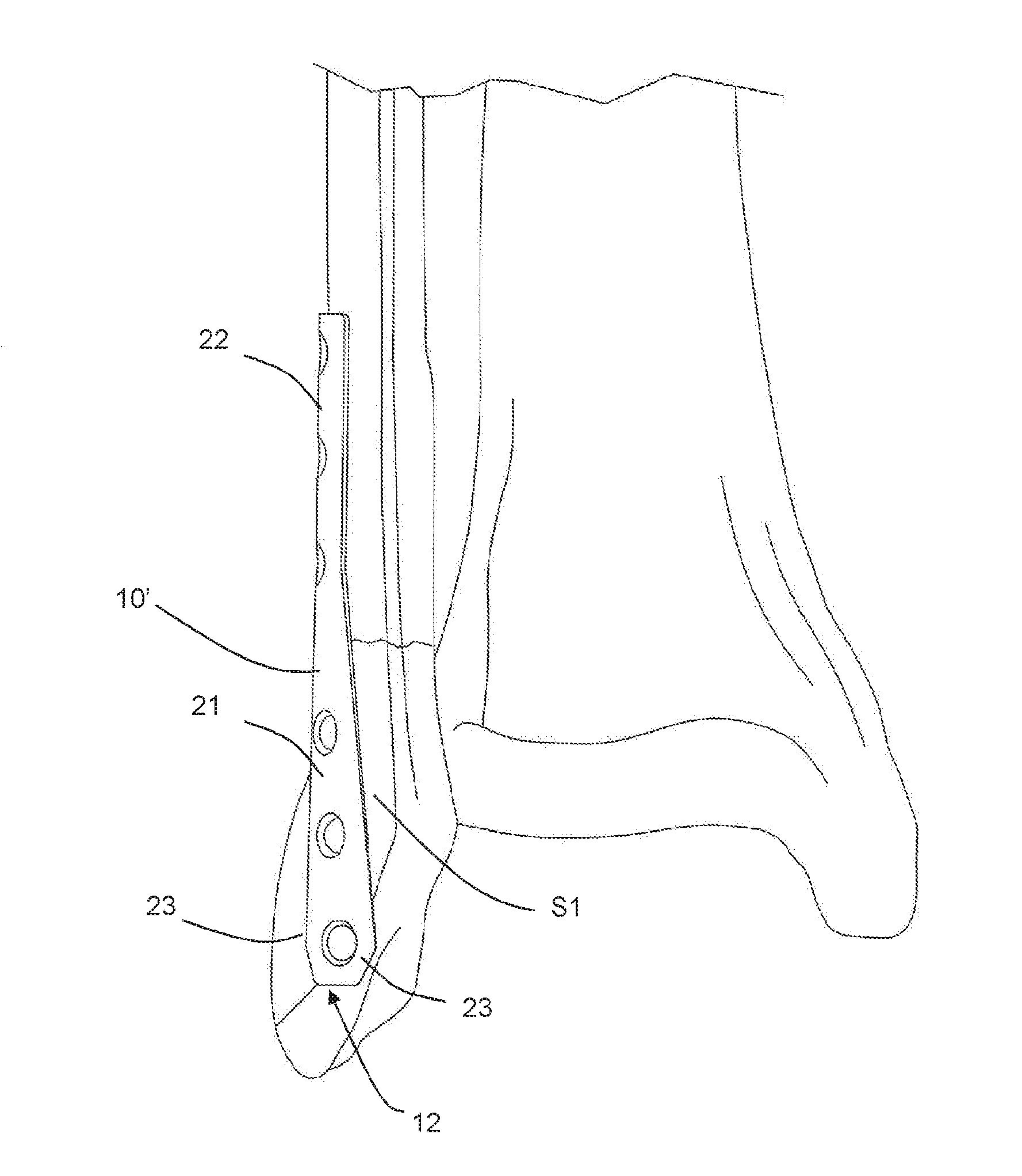 Osteosynthesis plate for distal fibula / lateral malleoulus