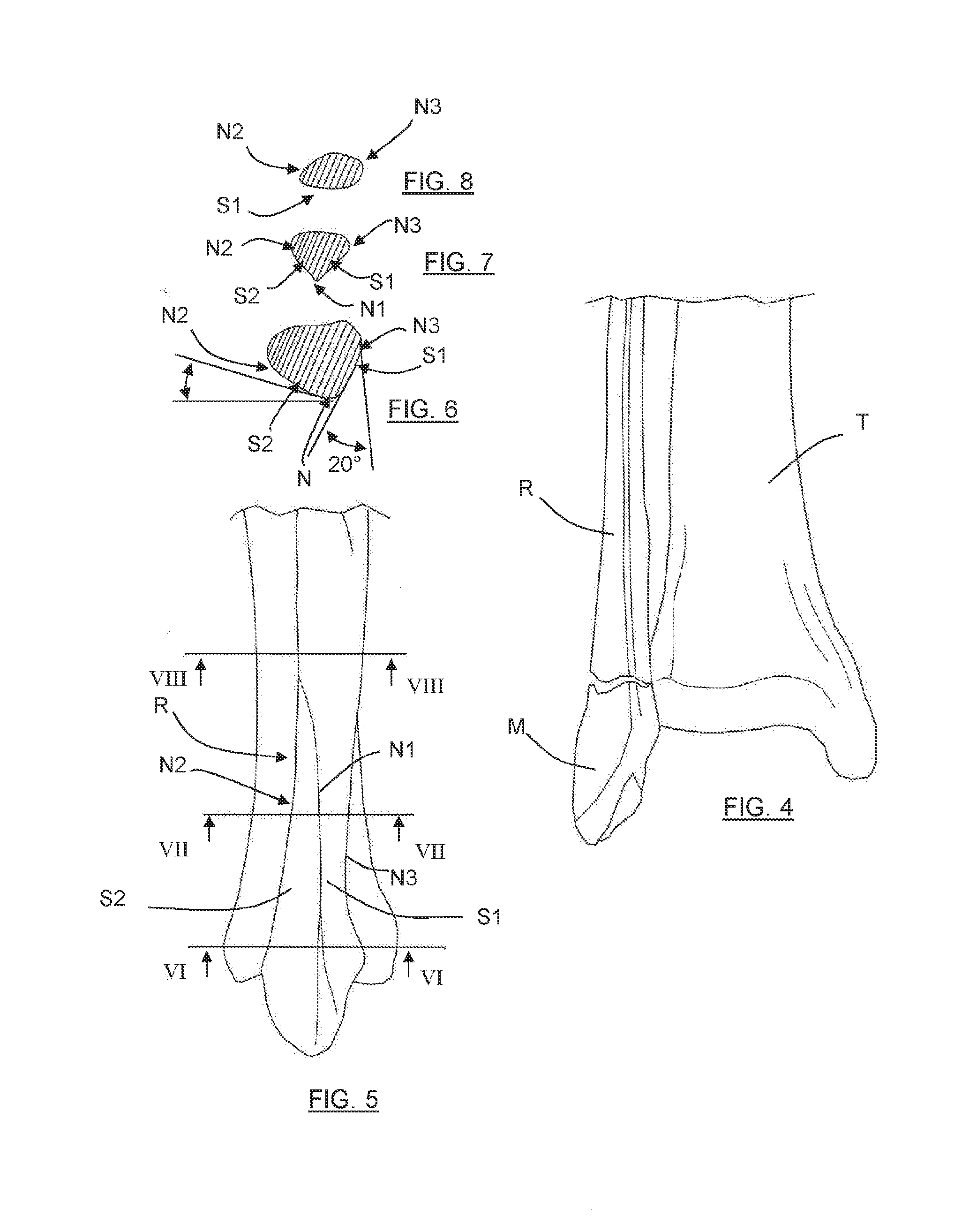 Osteosynthesis plate for distal fibula / lateral malleoulus