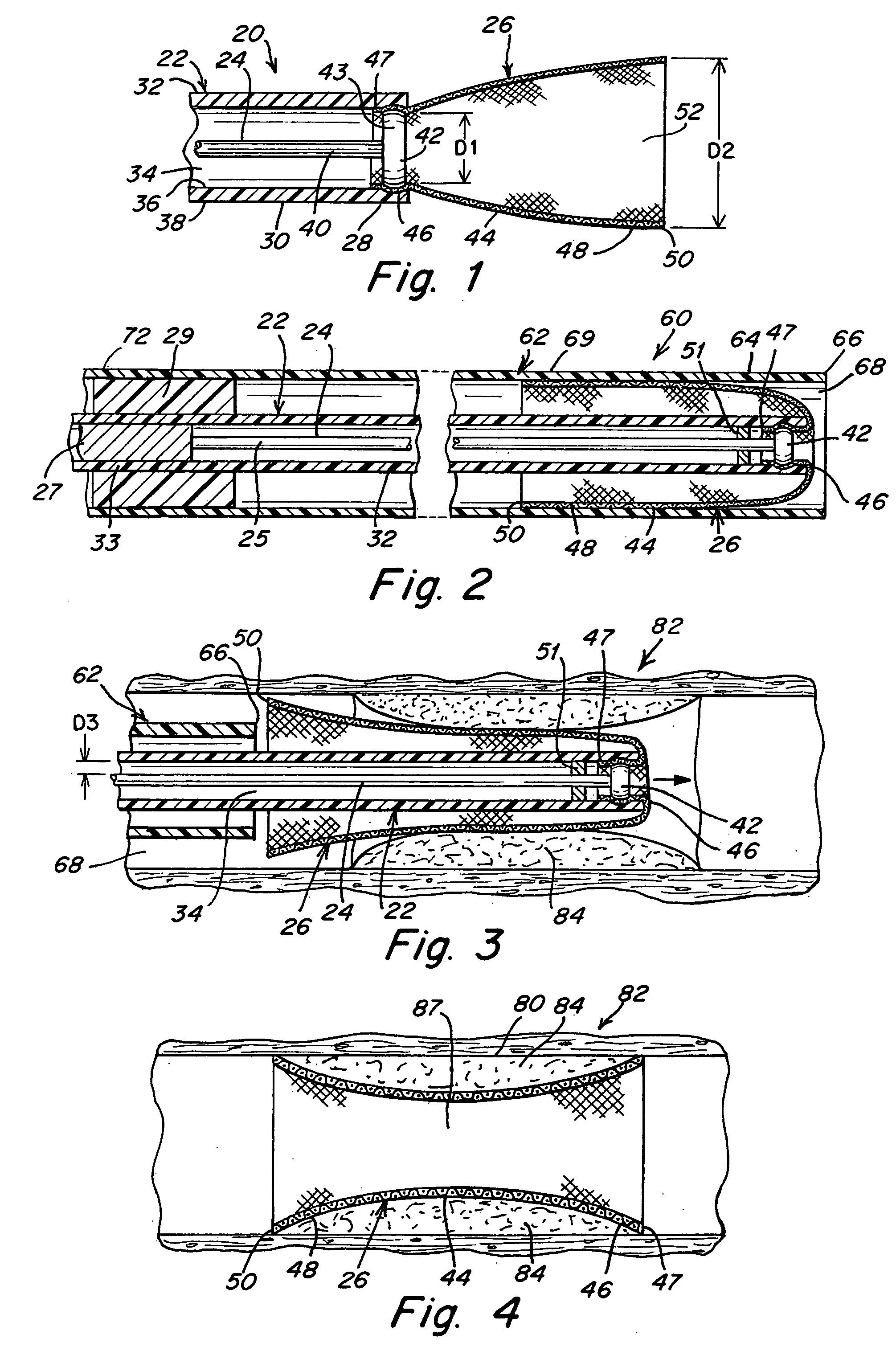 Everting stent and stent delivery system