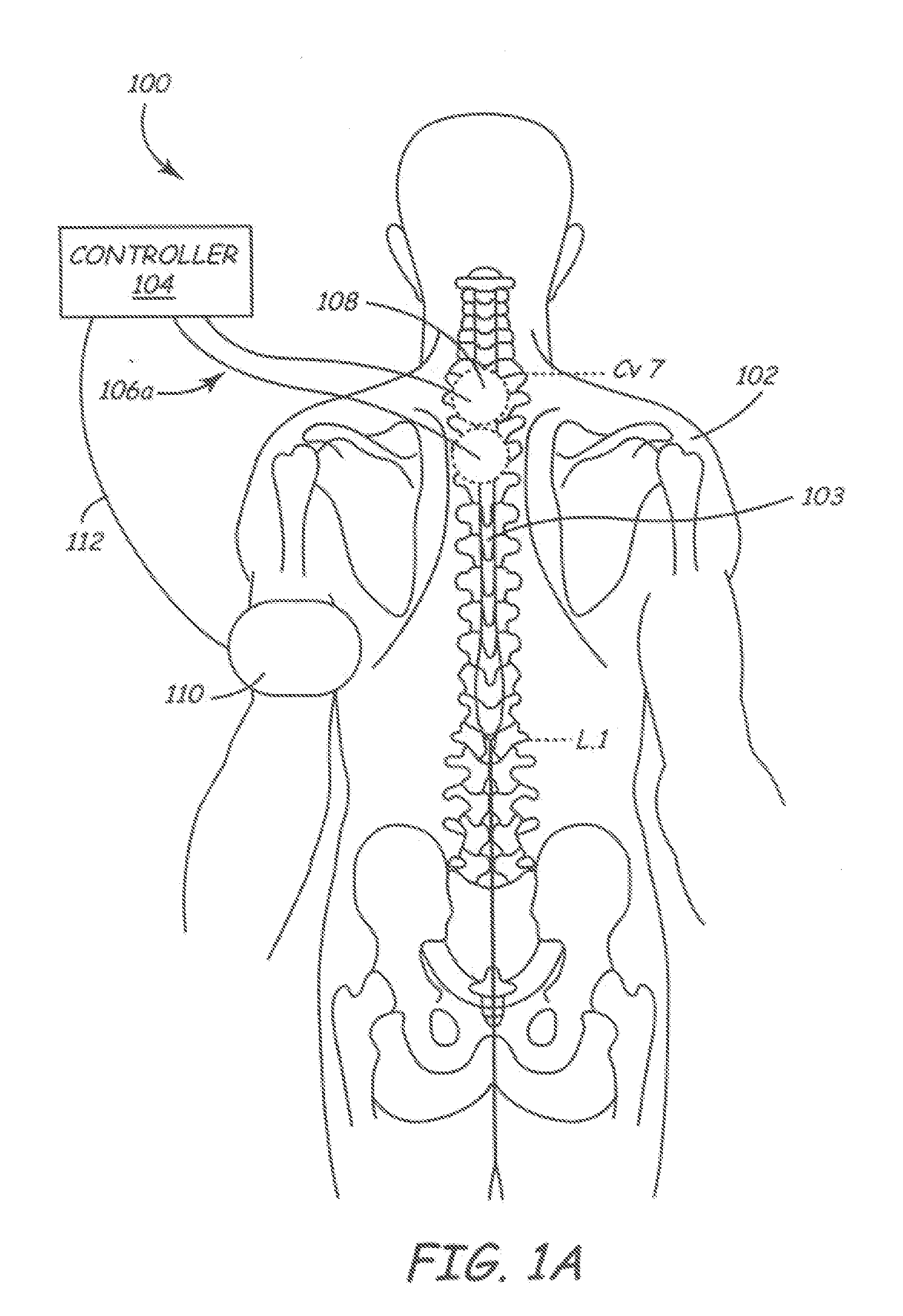 Closed-Loop Neuromodulation for Prevention and Treatment of Cardiac Conditions