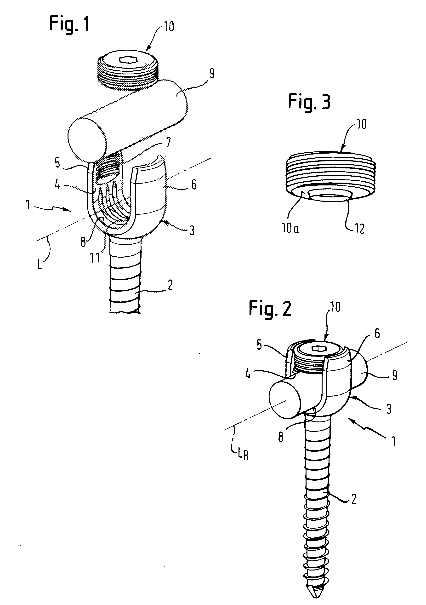 Bone anchoring device