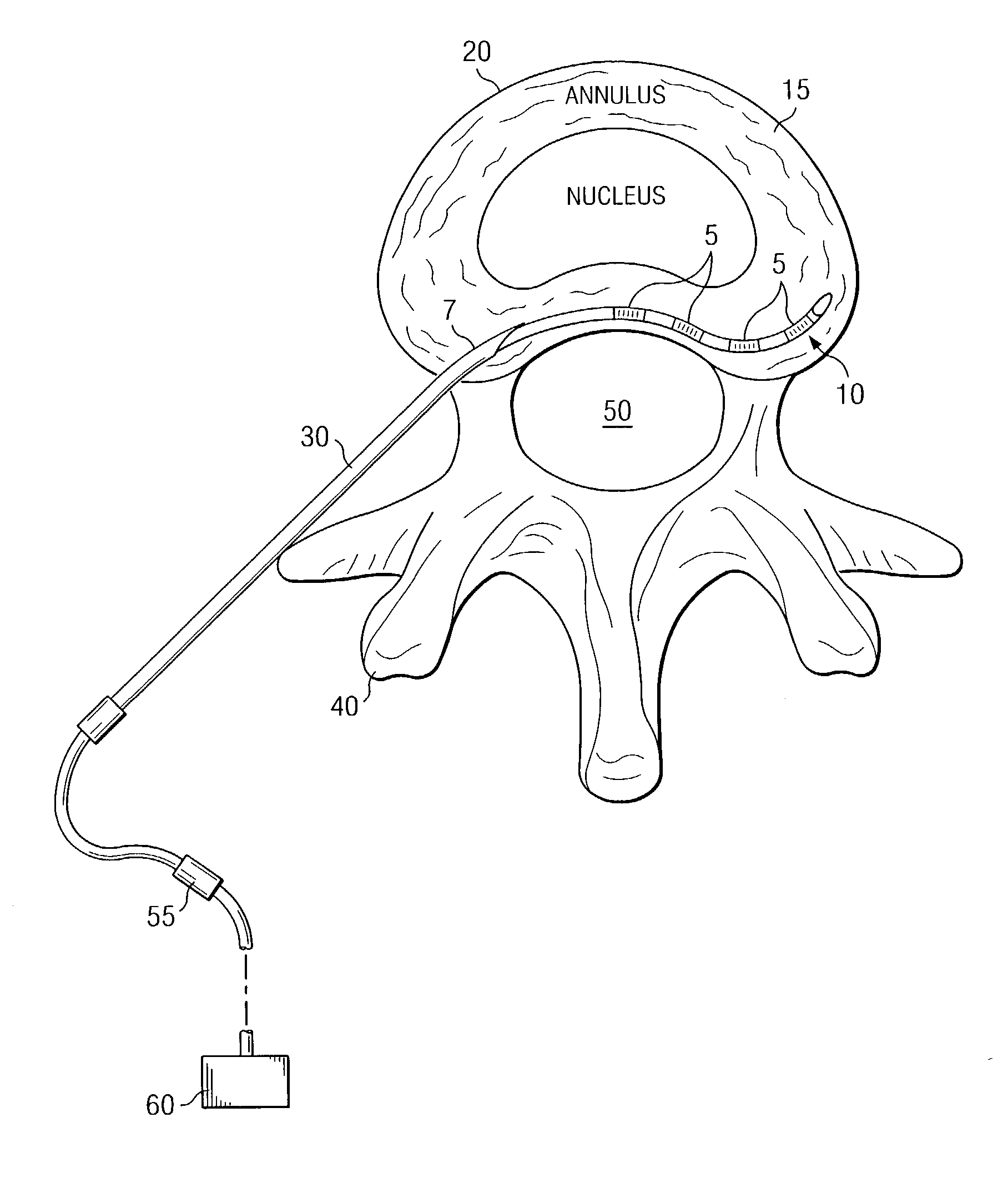 System and method for electrical stimulation of the intervertebral disc