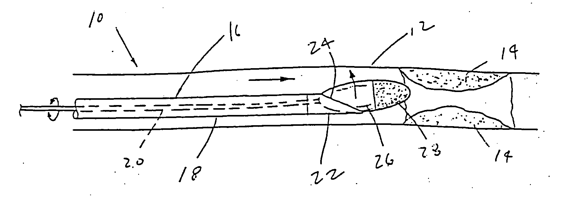 Ablation burr