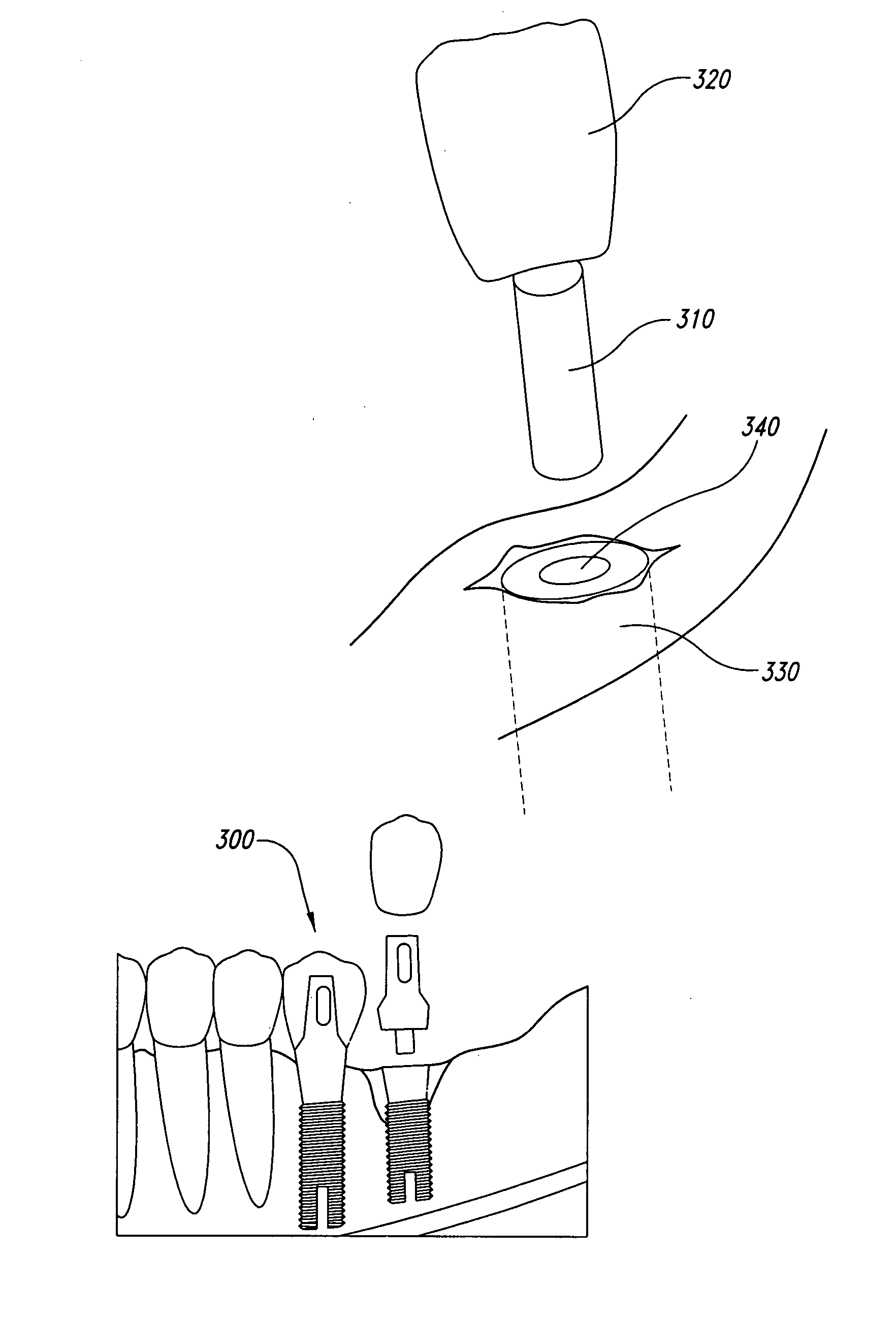 Method and system for repairing endosseous implants, such as with a bone graft implant