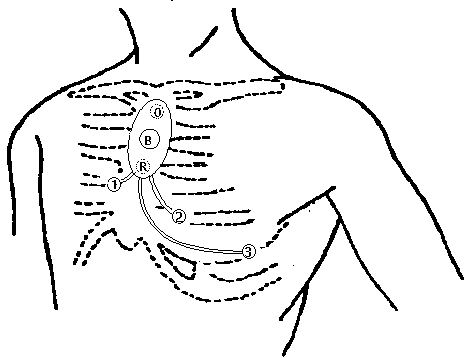 Multi-lead wearable electrocardiograph monitoring device