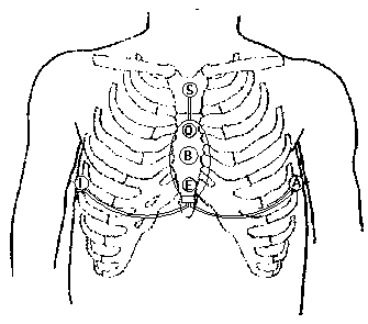 Multi-lead wearable electrocardiograph monitoring device