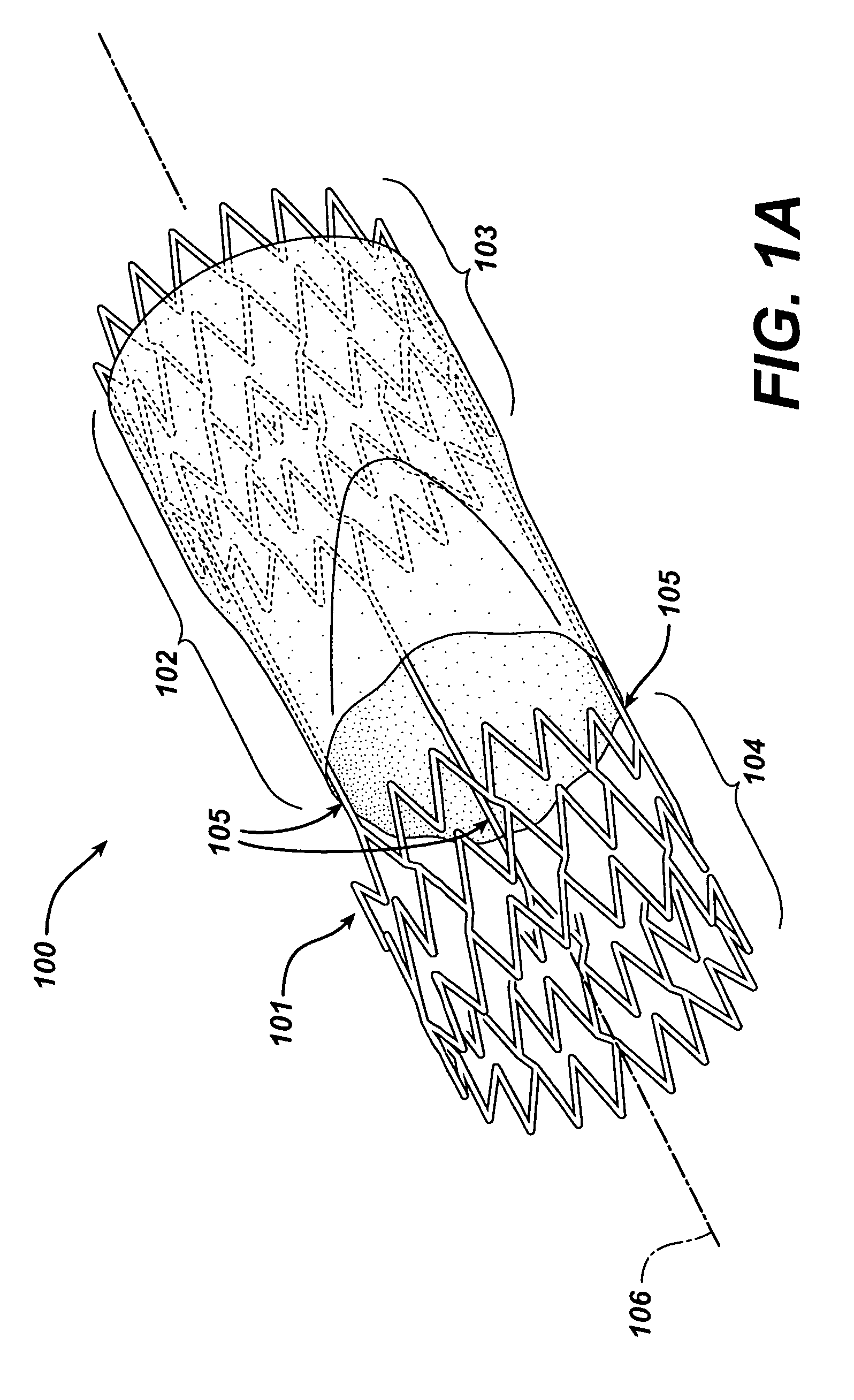 Frame based unidirectional flow prosthetic implant