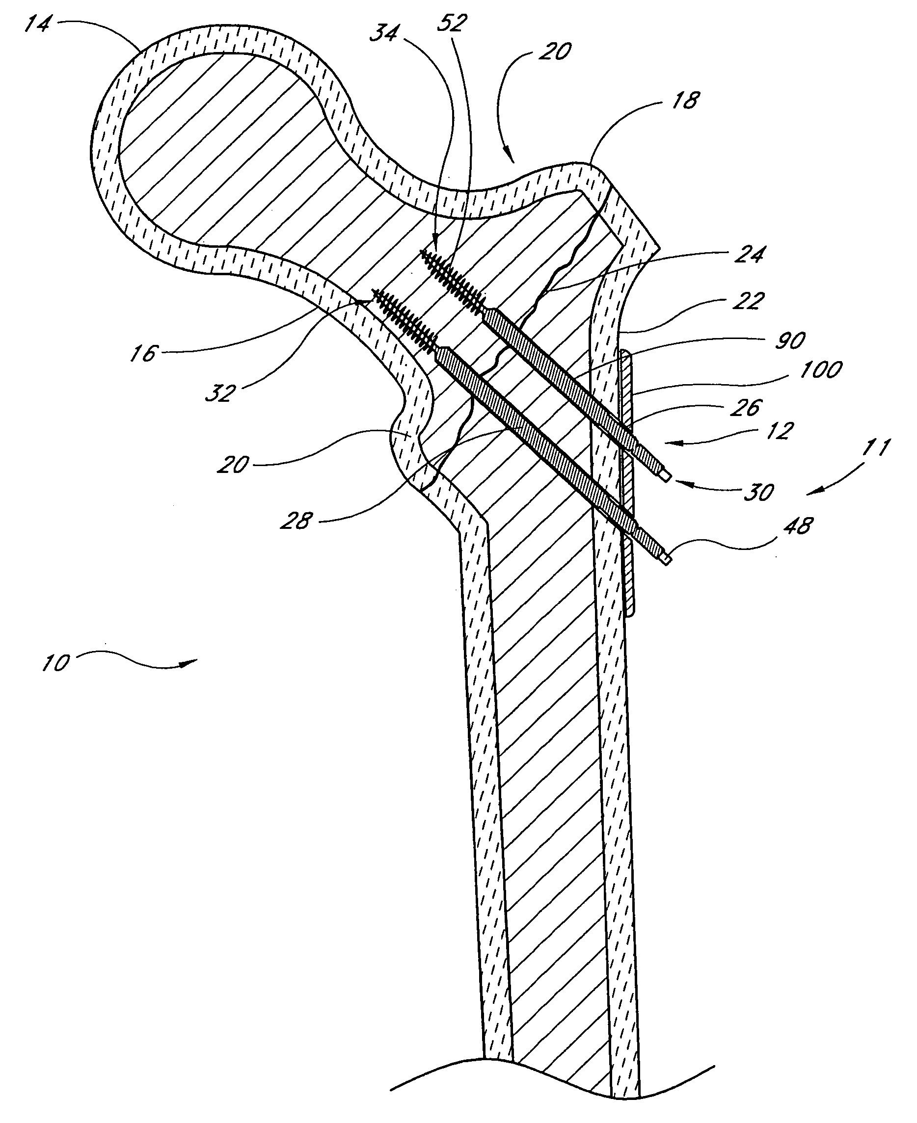 Locking plate for bone anchors