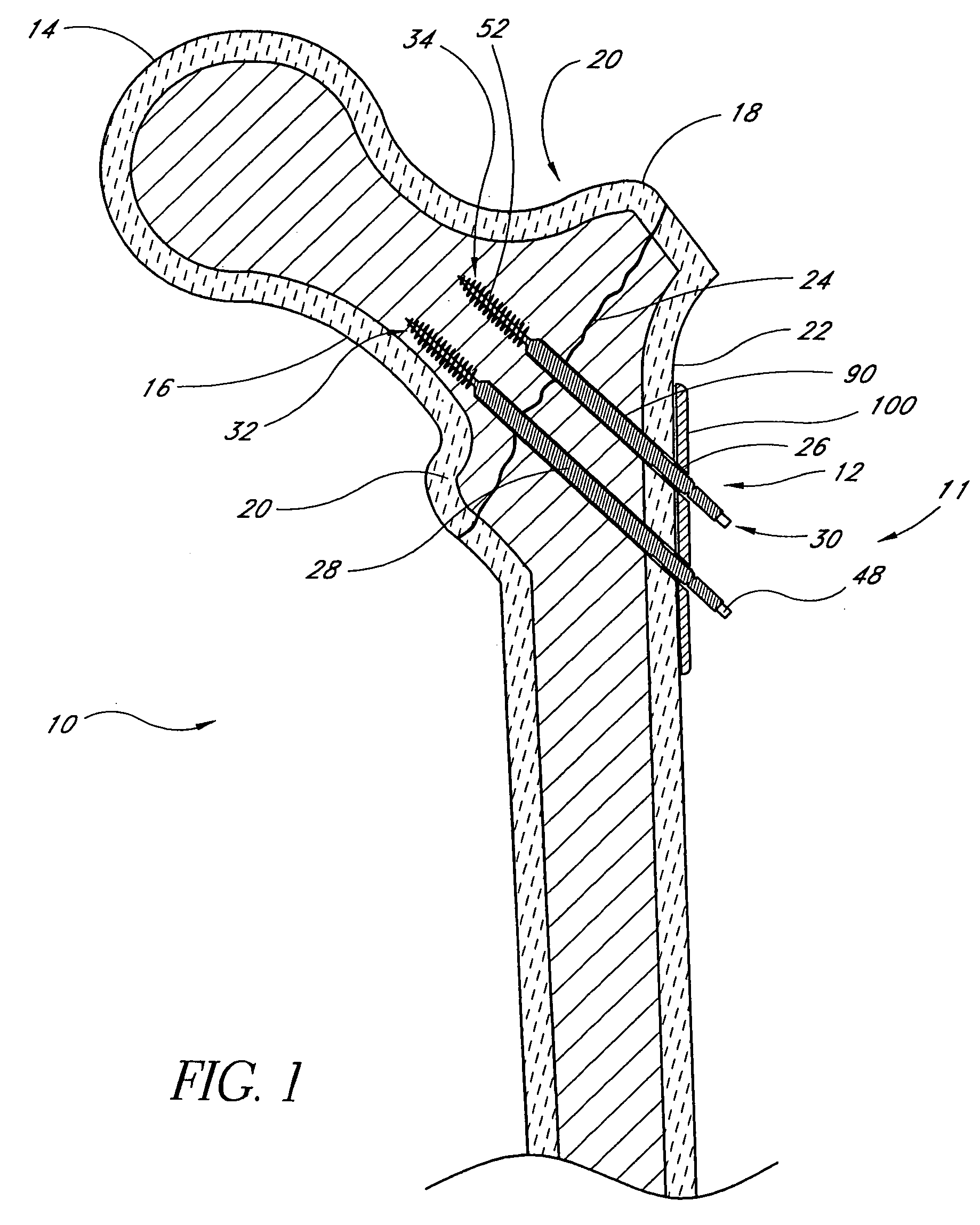 Locking plate for bone anchors