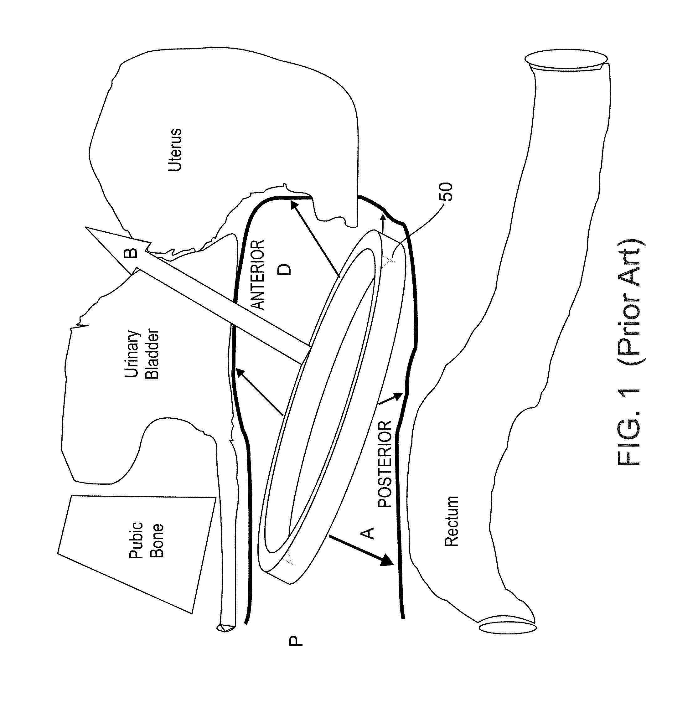 Vaginal carrier for the controlled release of substances