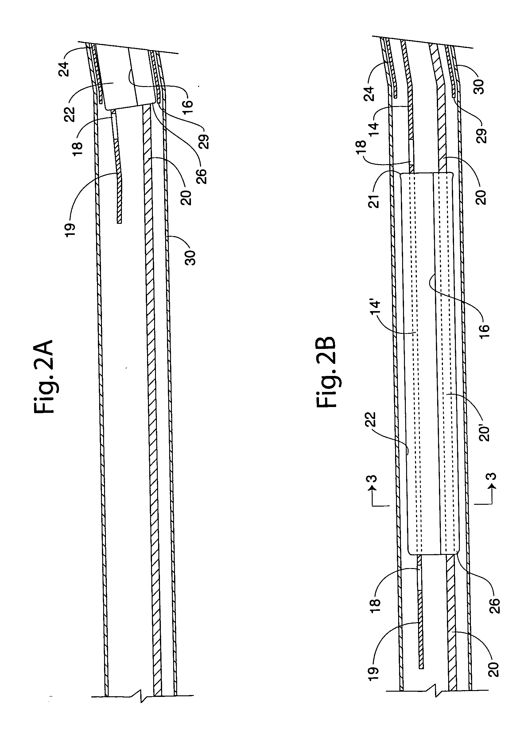 Method for placing a stent through a constricted lumen, and medical device