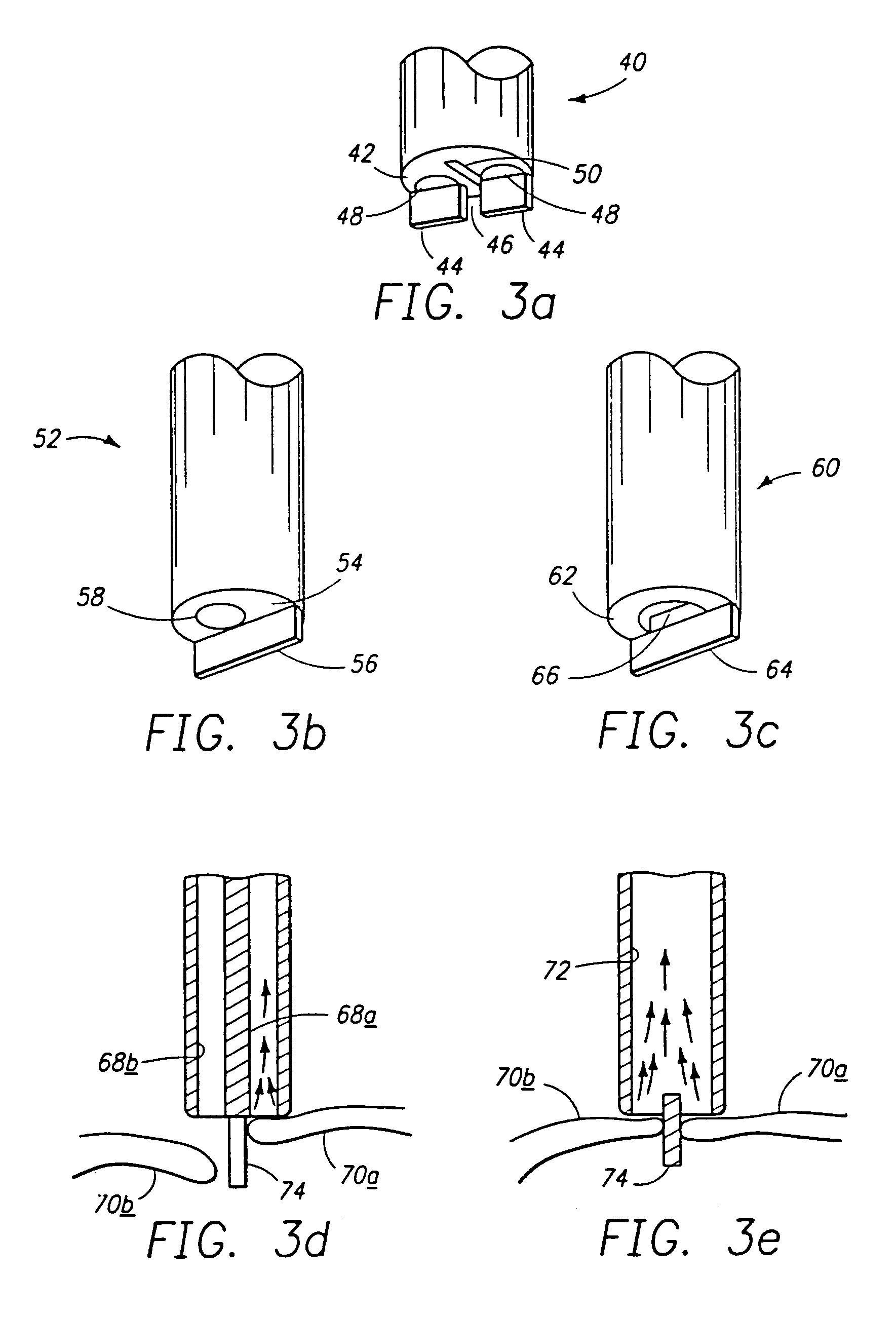 Minimally invasive mitral valve repair method and apparatus