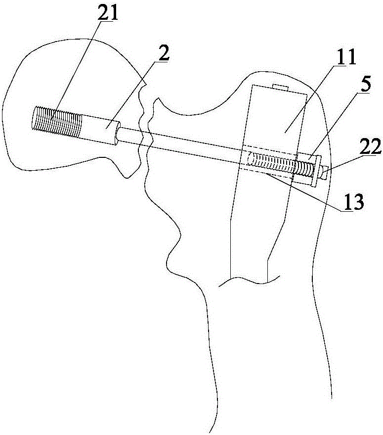 Intertrochanteric fracture intramedullary fixation system