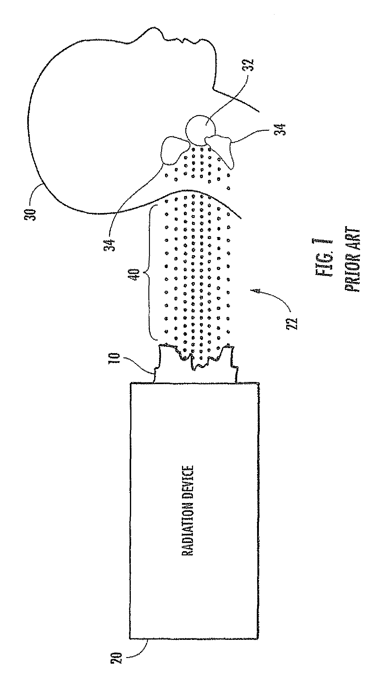 Radiation therapy using beam modifiers placed against a patient's skin