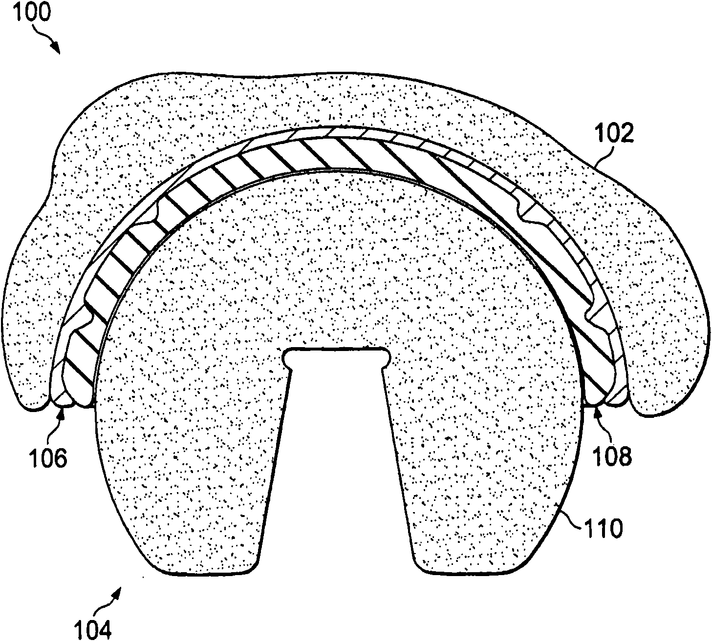 Acetabular prosthetic devices