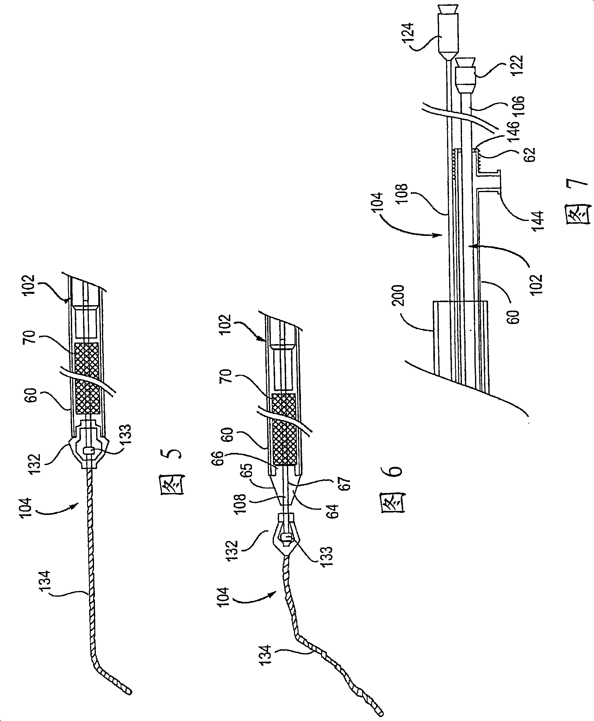 Apparatus and methods for protected angioplasty and stenting at a carotid bifurcation