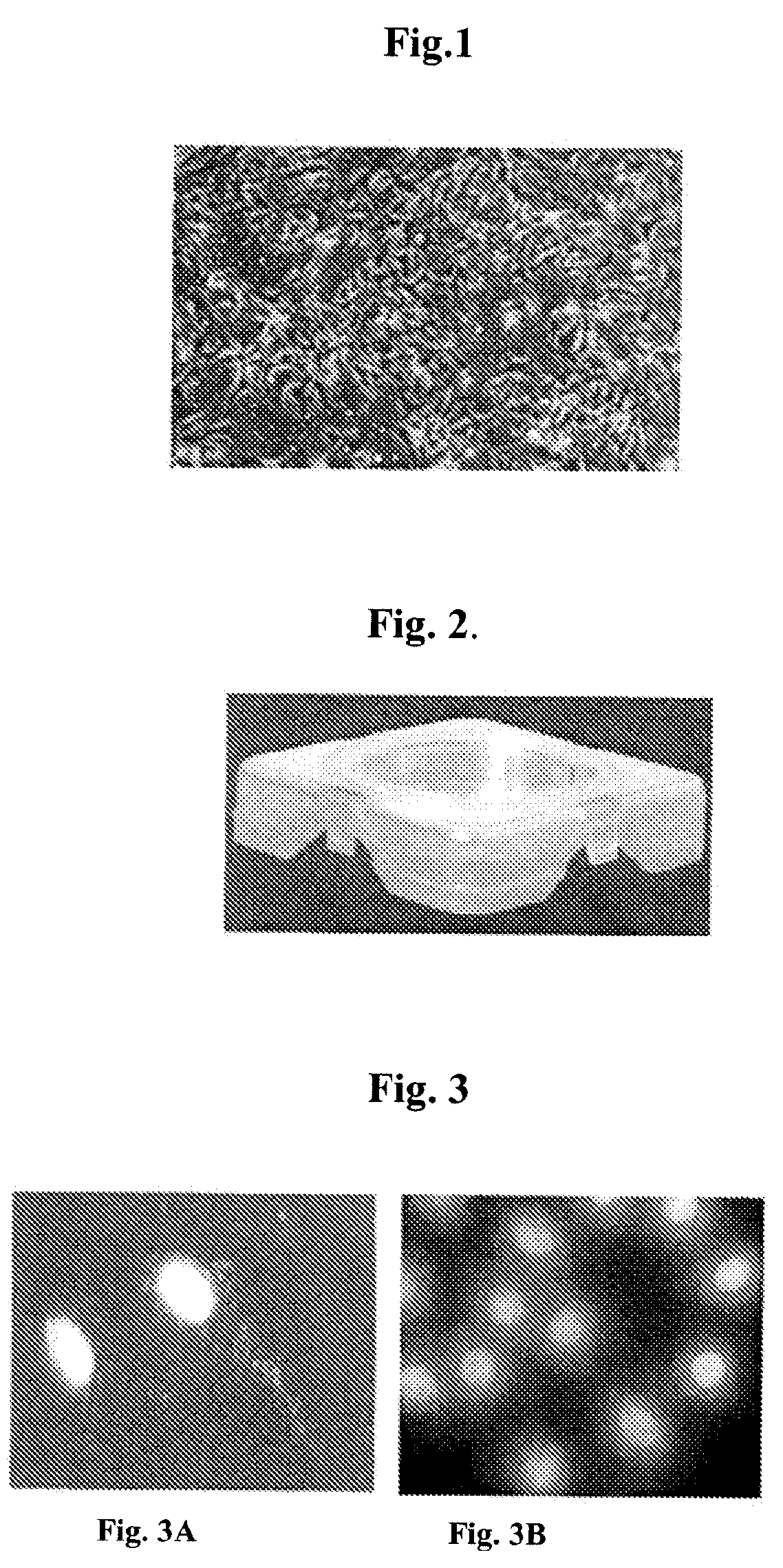 Cultured Melanocytes on Bioploymer Membranes for Treatment of Hyper and Hypopigmentation Disorders