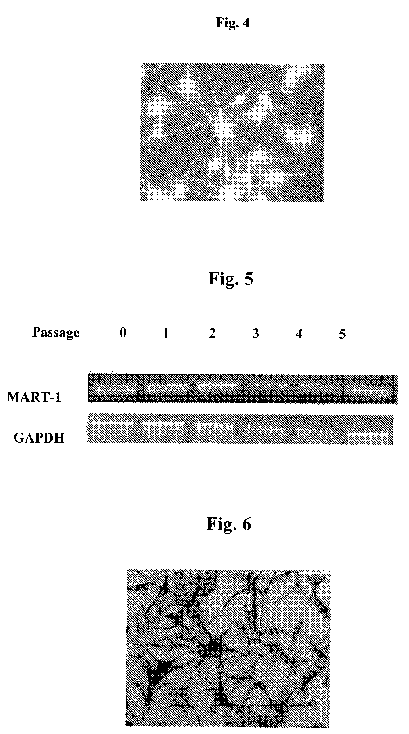 Cultured Melanocytes on Bioploymer Membranes for Treatment of Hyper and Hypopigmentation Disorders