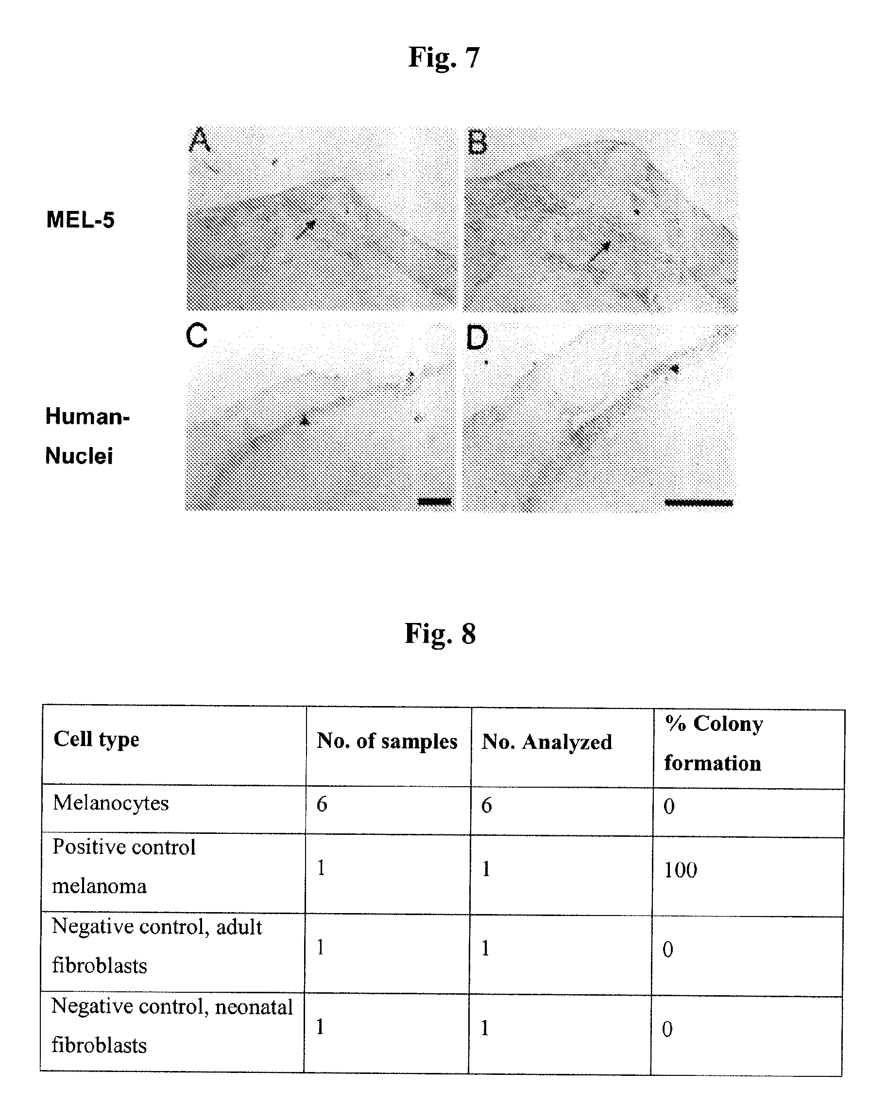 Cultured Melanocytes on Bioploymer Membranes for Treatment of Hyper and Hypopigmentation Disorders