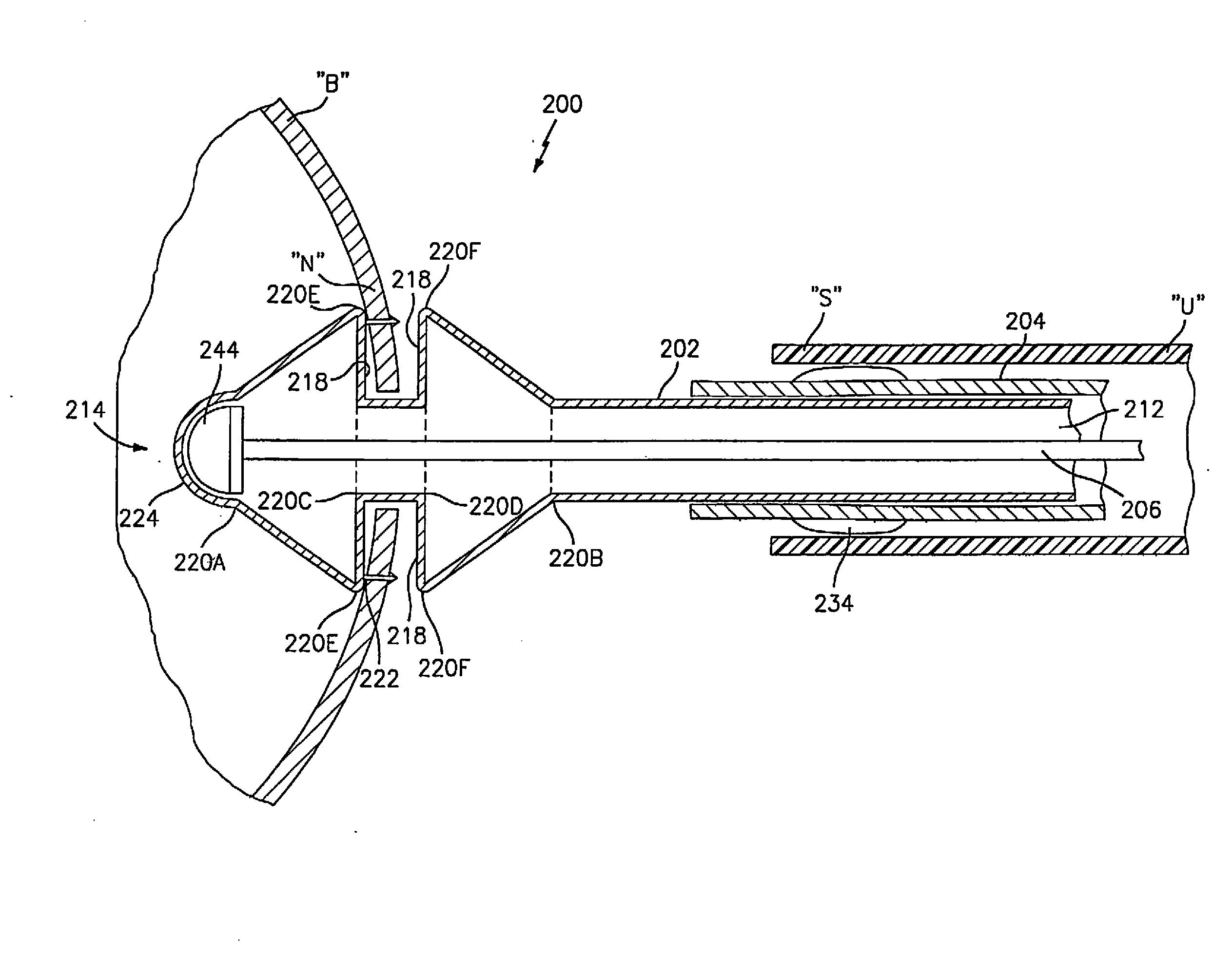 Method and apparatus for anastomosis including an anchoring sleeve