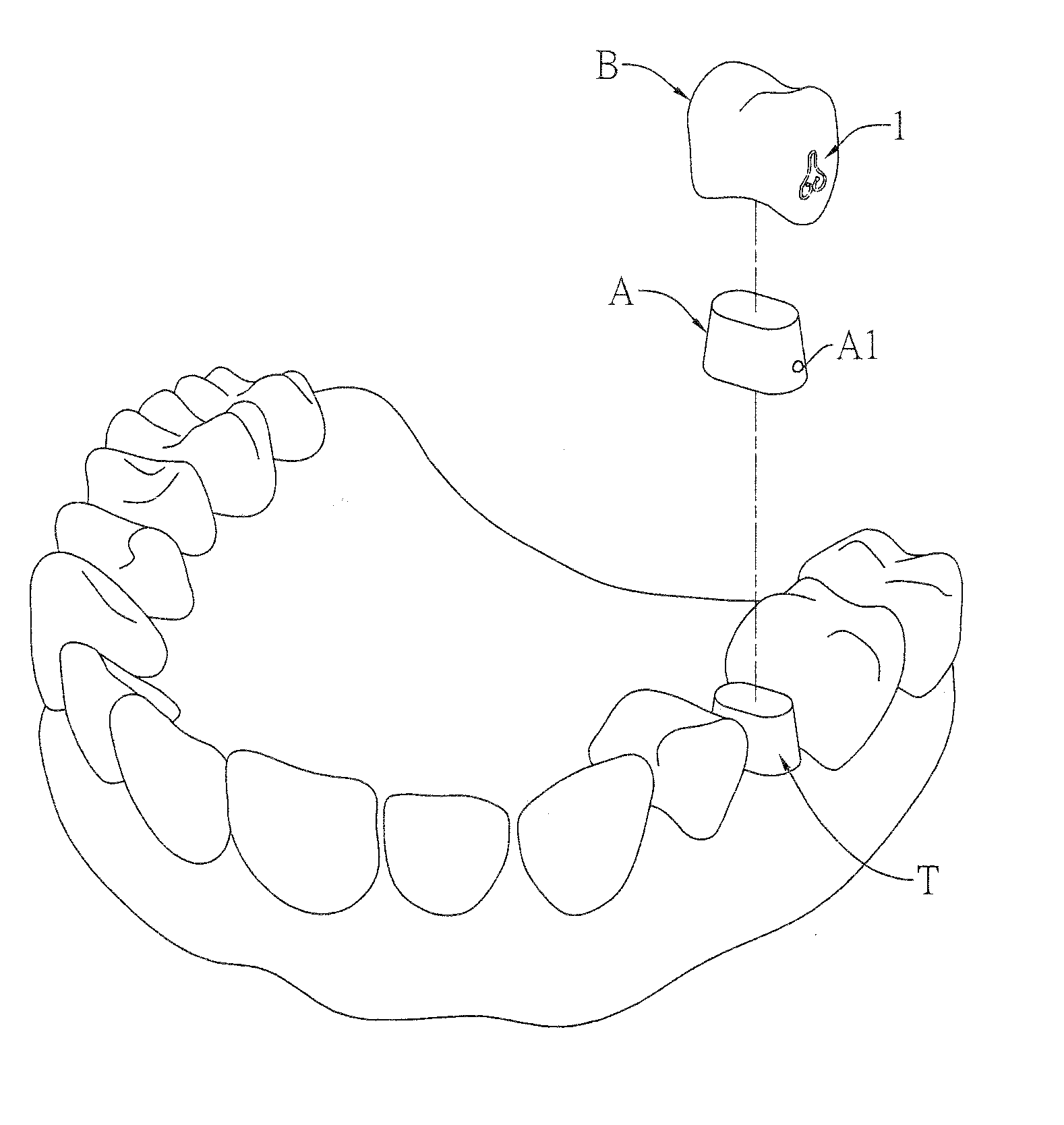 Spring clip mounted to withdrawable artificial tooth and removable artificial tooth assembled with same