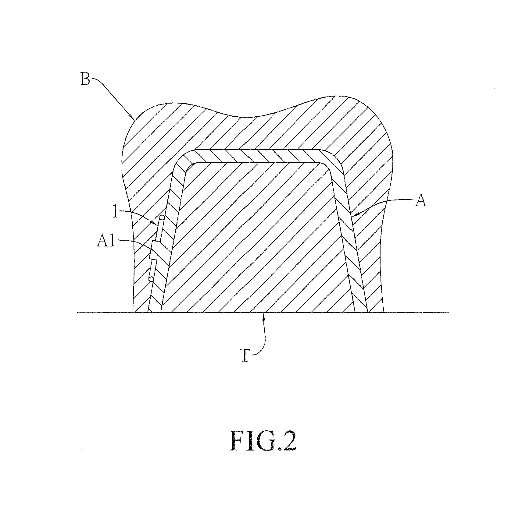 Spring clip mounted to withdrawable artificial tooth and removable artificial tooth assembled with same