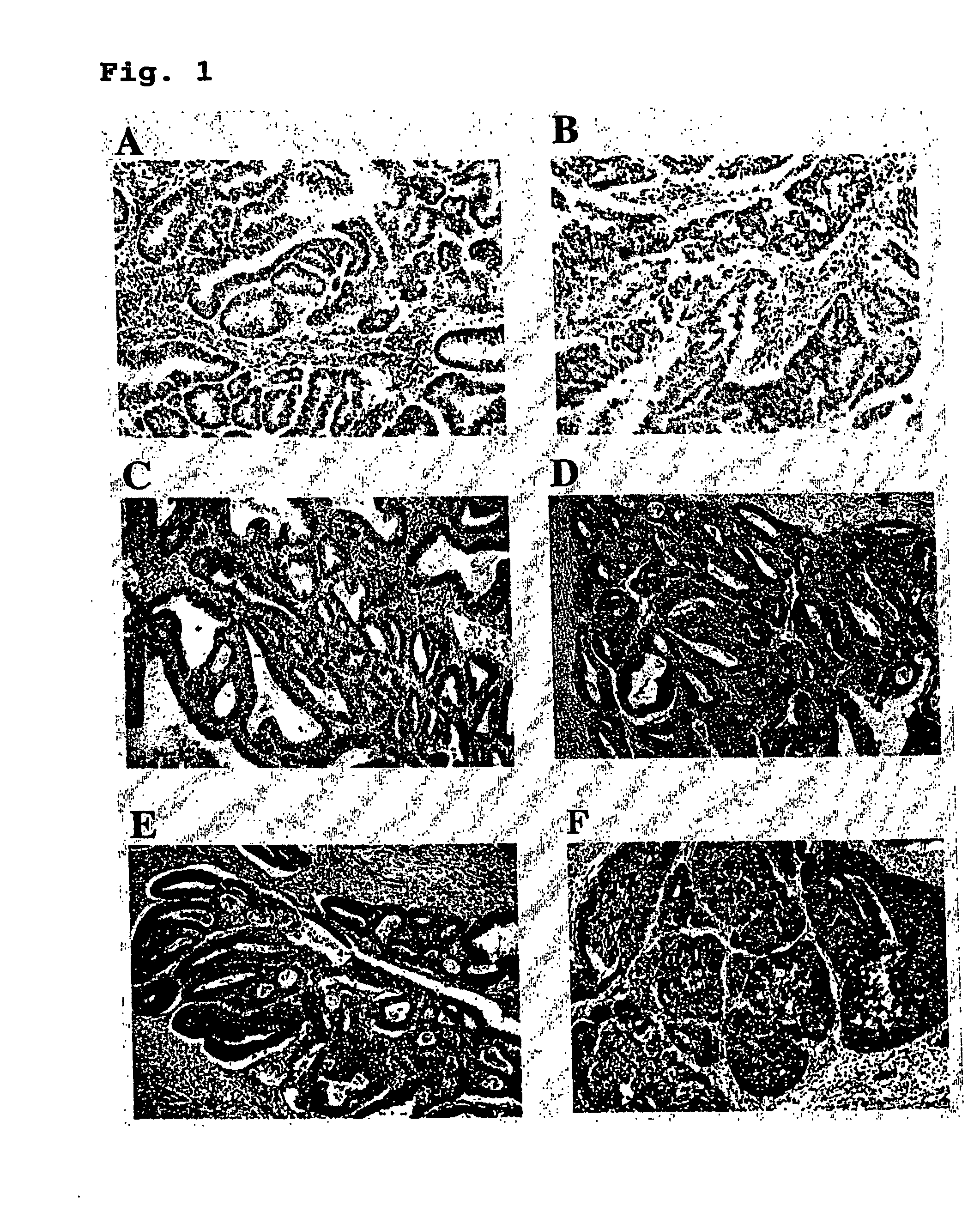 Method for prognostic evaluation of carcinoma using anti-p-lap antibody