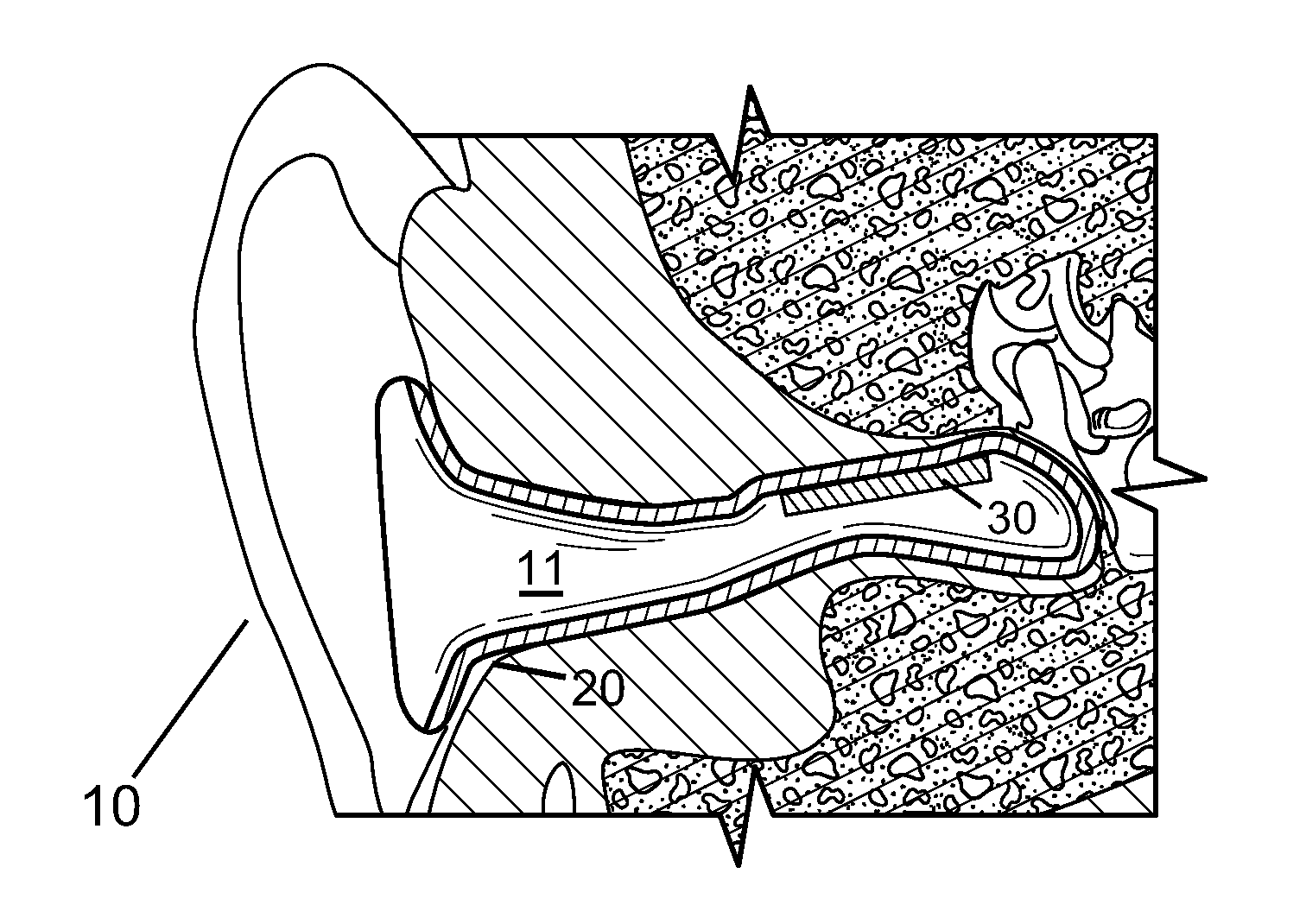 Vestibular stimulation apparatus and associated methods of use