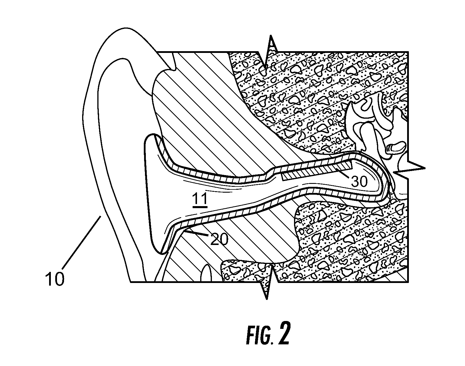 Vestibular stimulation apparatus and associated methods of use