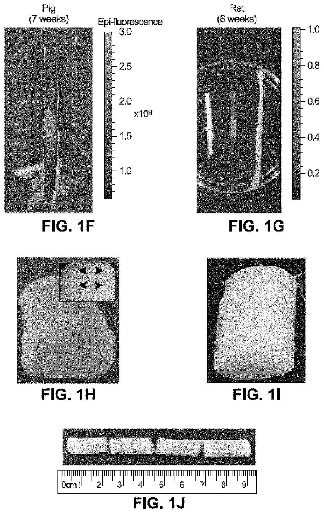 Spinal subpial gene delivery system