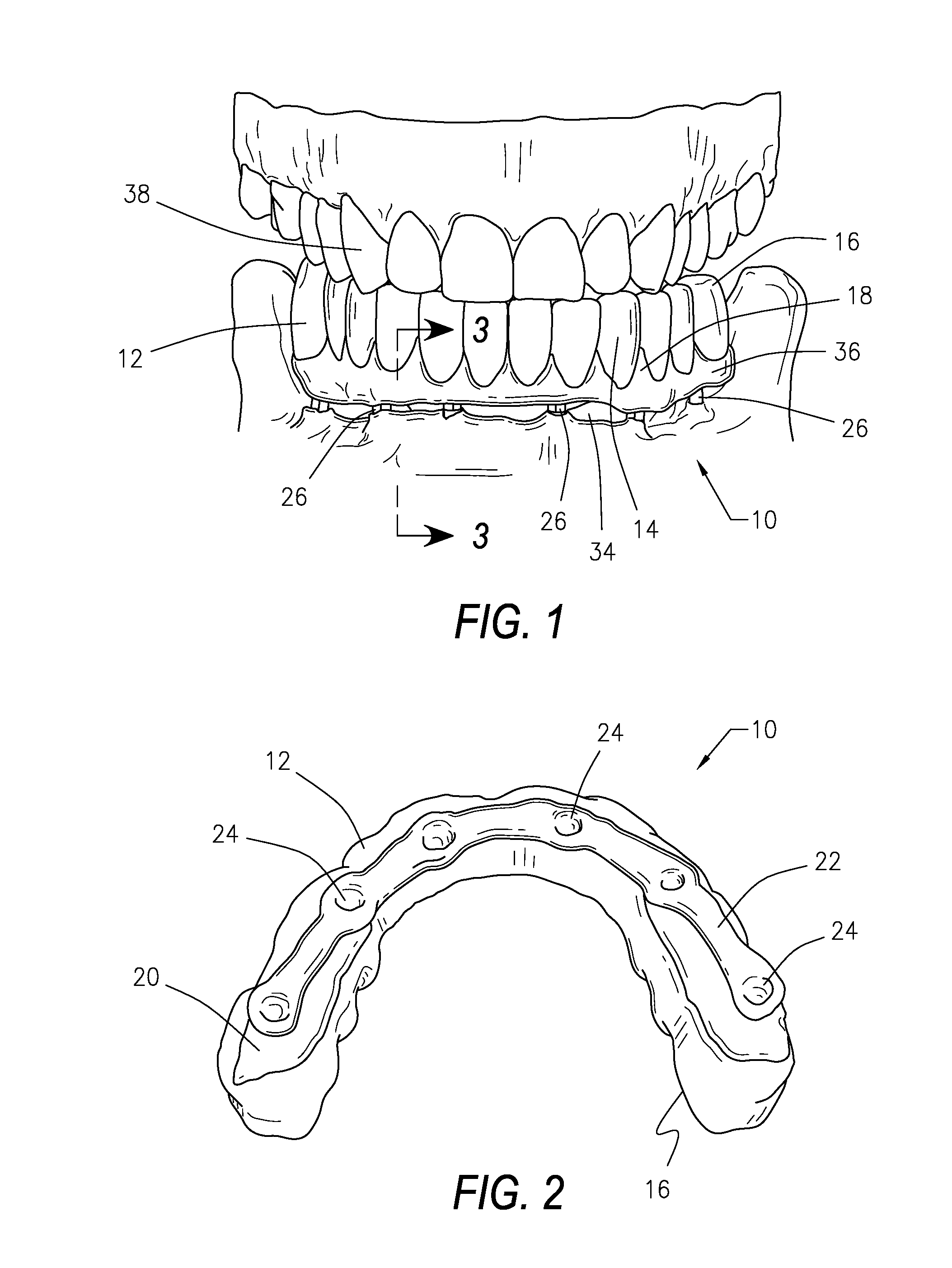 Fixed, Implant-Supported, Full Arch Dental Prosthetics and Methods of Seating Thereof