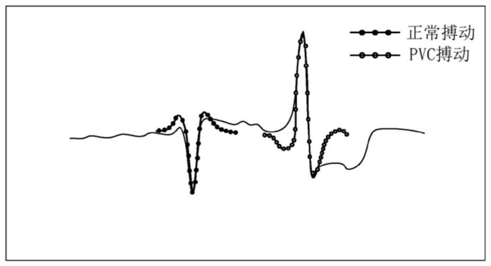 Systems and methods for determining premature ventricular contraction (pvc) type and load