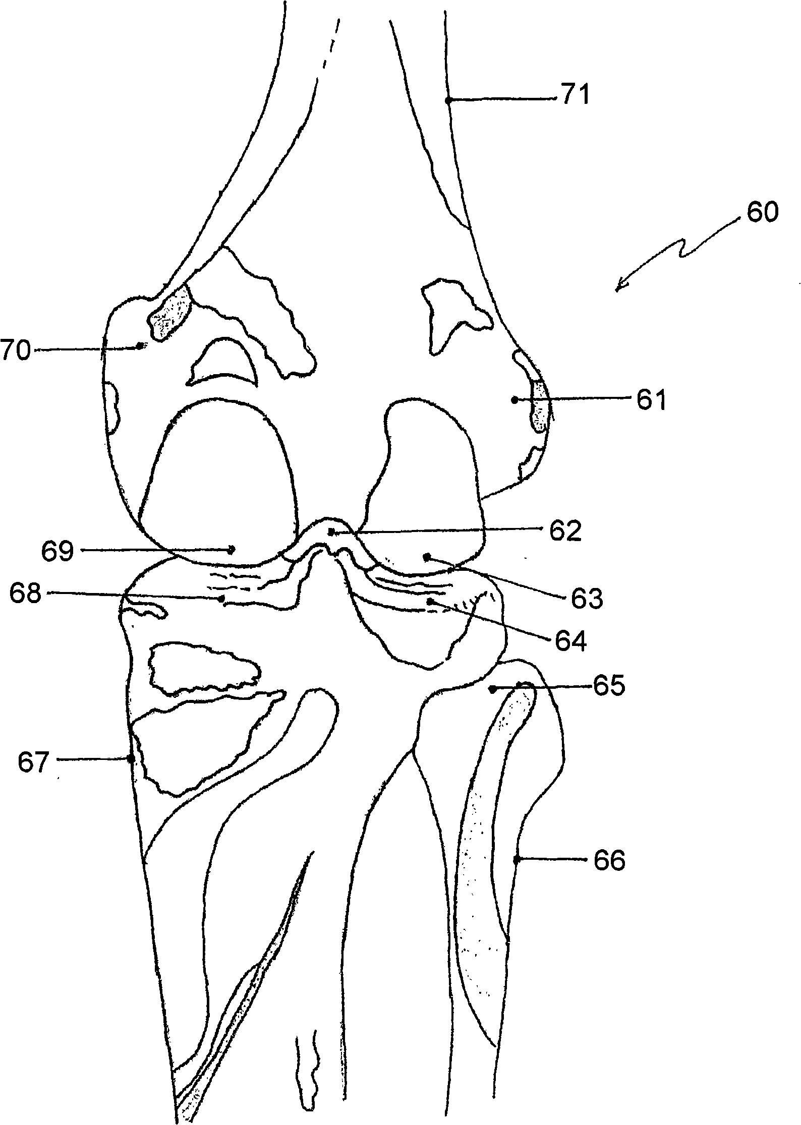 Knee joint prosthesis