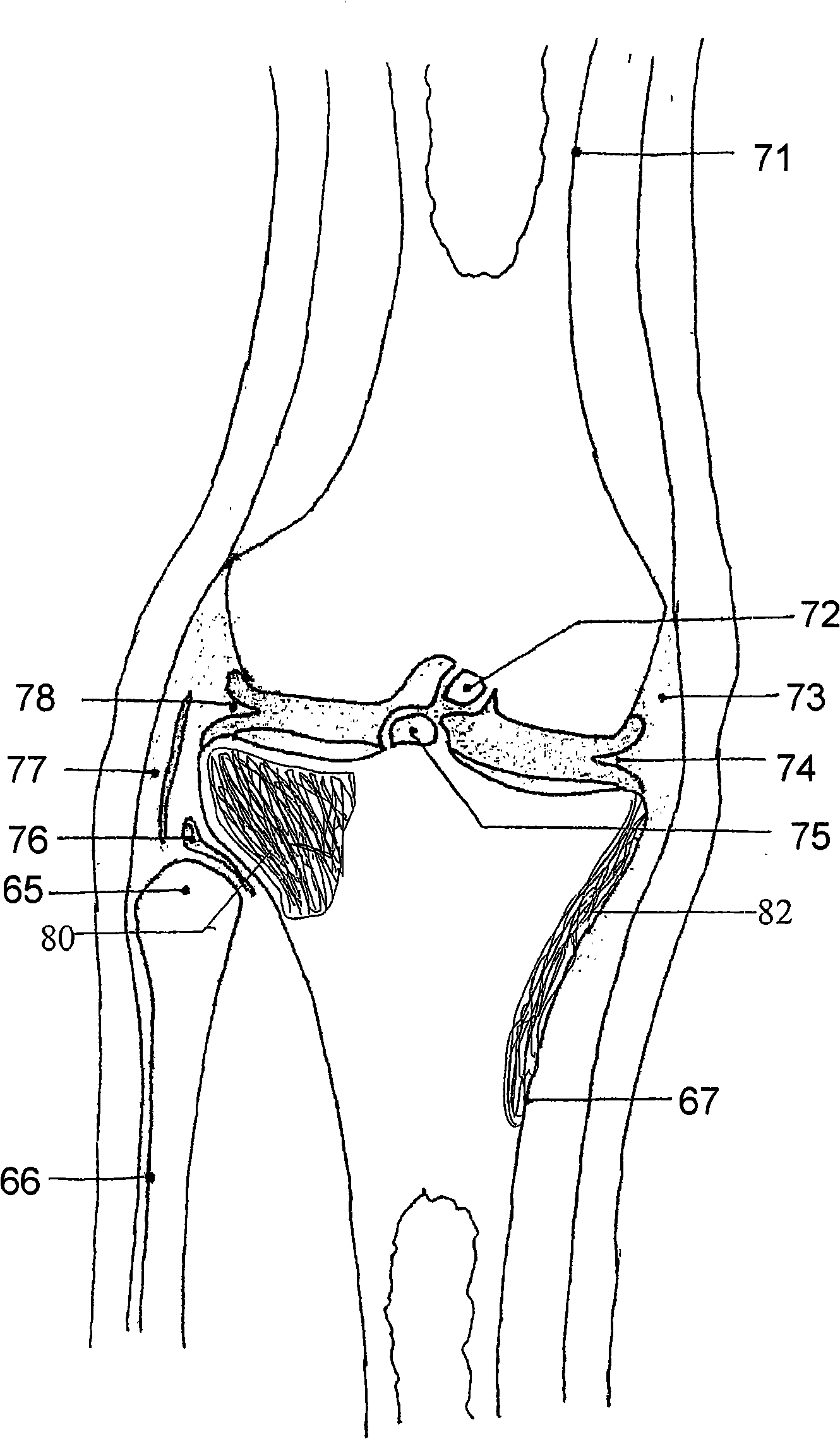 Knee joint prosthesis