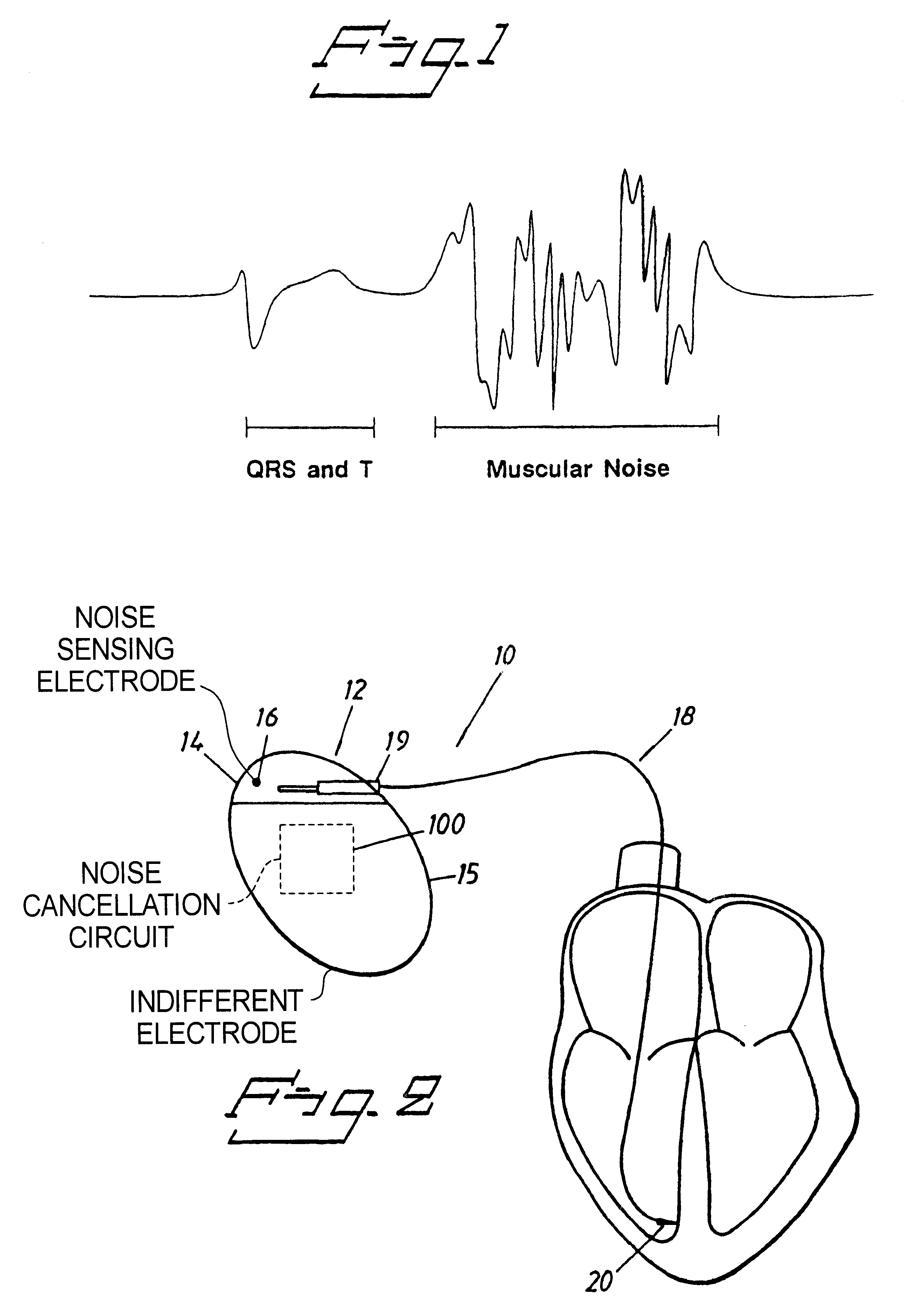 Implantable cardiac stimulator with circuitry for removing noise in sensed electrical signals