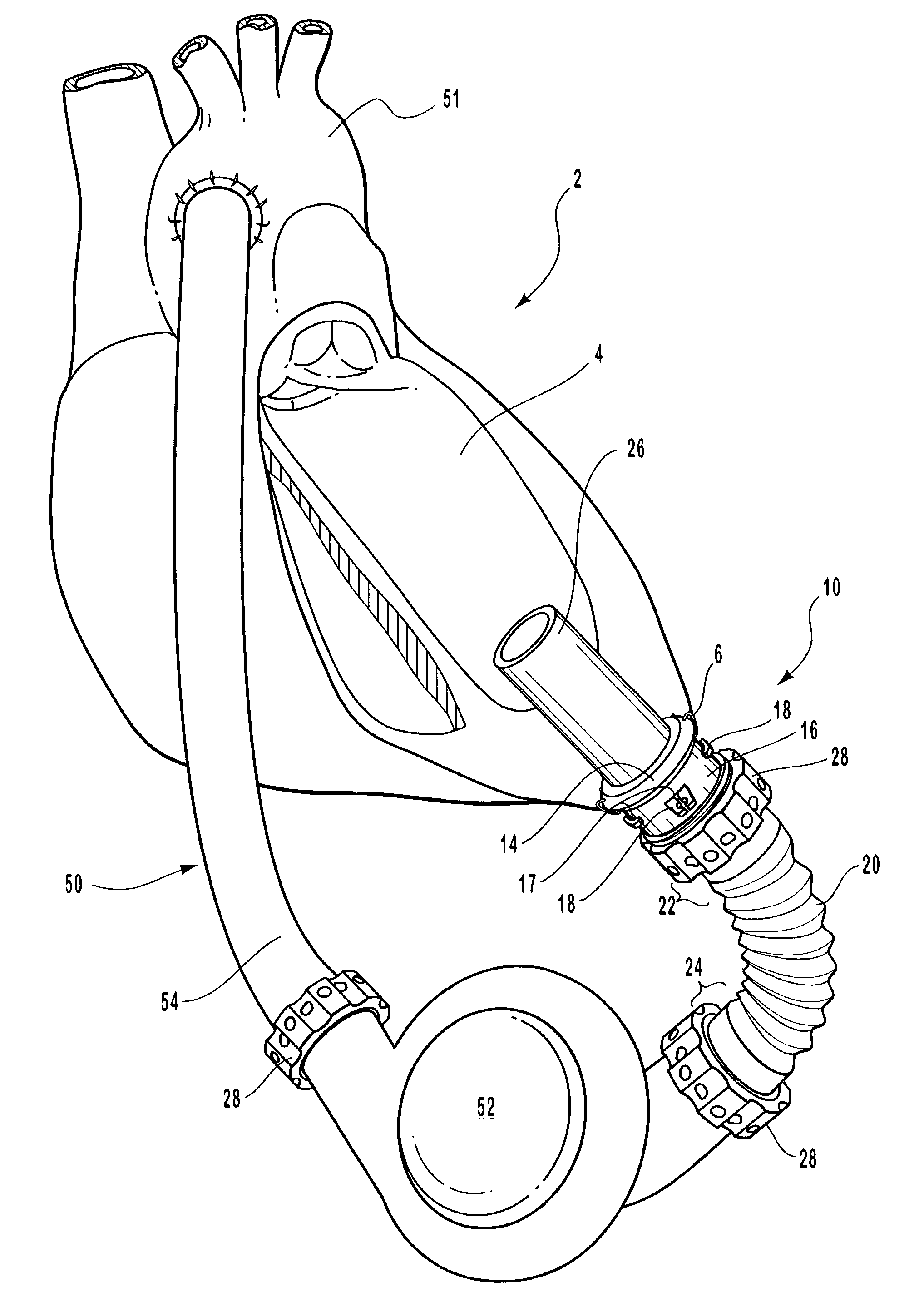 Cannulation apparatus and method