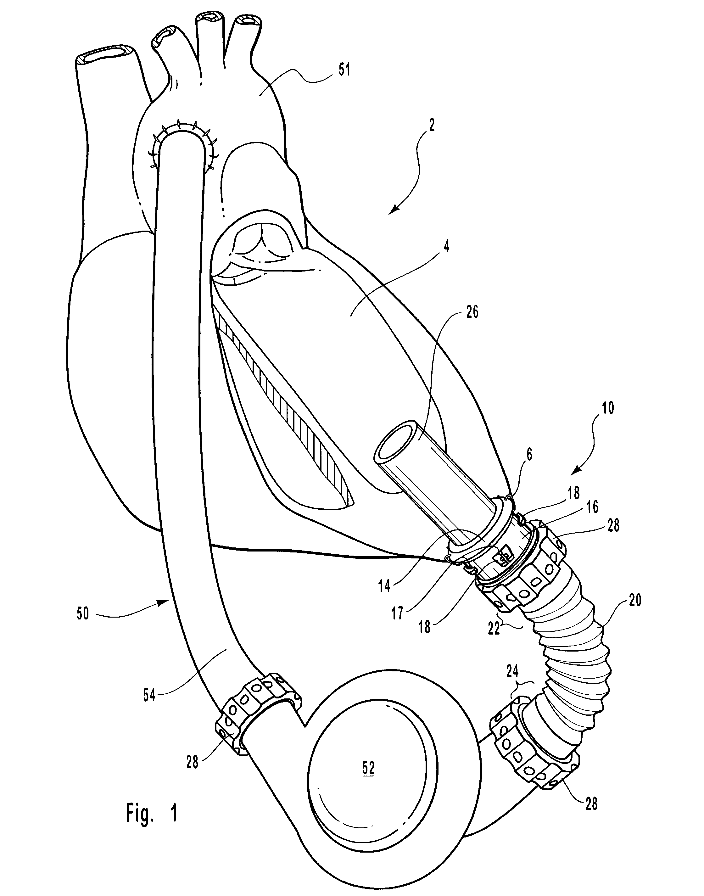 Cannulation apparatus and method