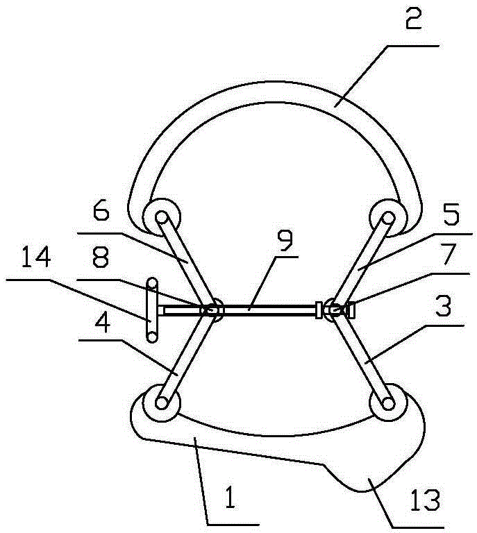 Mandibular condyle reposition expander