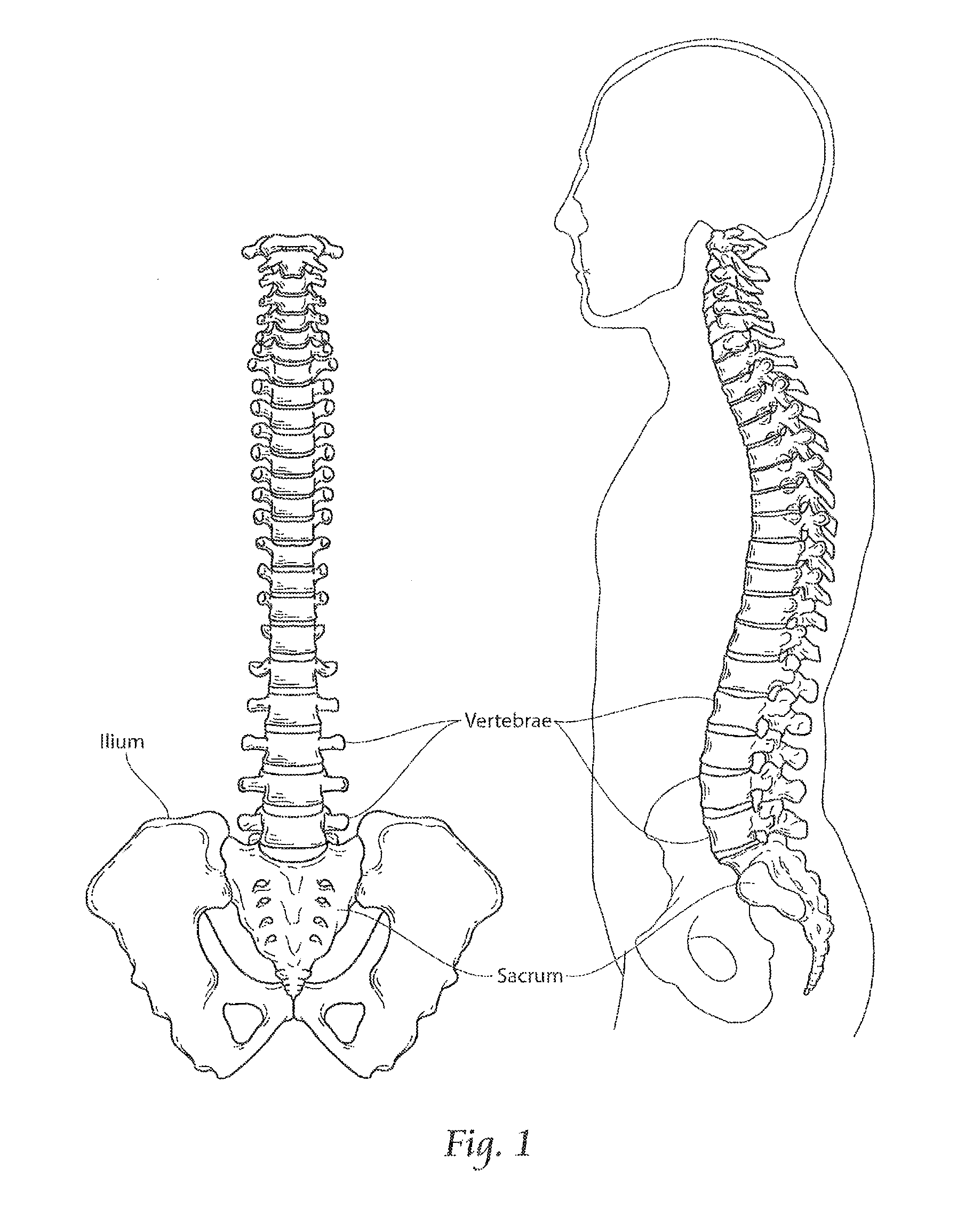 Apparatus, systems, and methods for stabilizing a spondylolisthesis