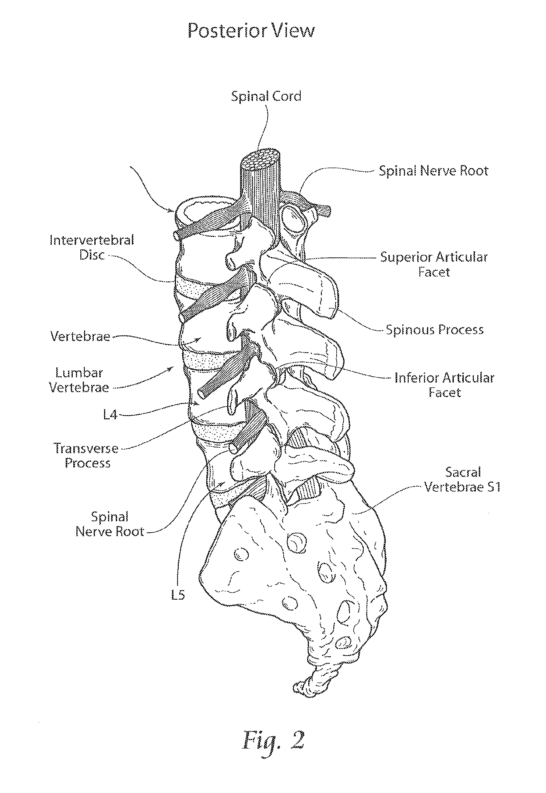 Apparatus, systems, and methods for stabilizing a spondylolisthesis