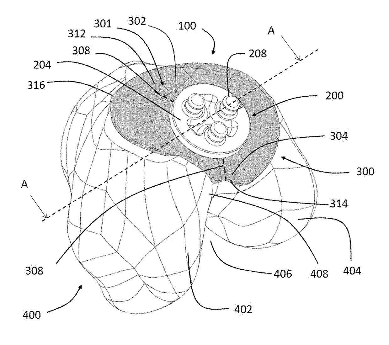 Patellofemoral implant