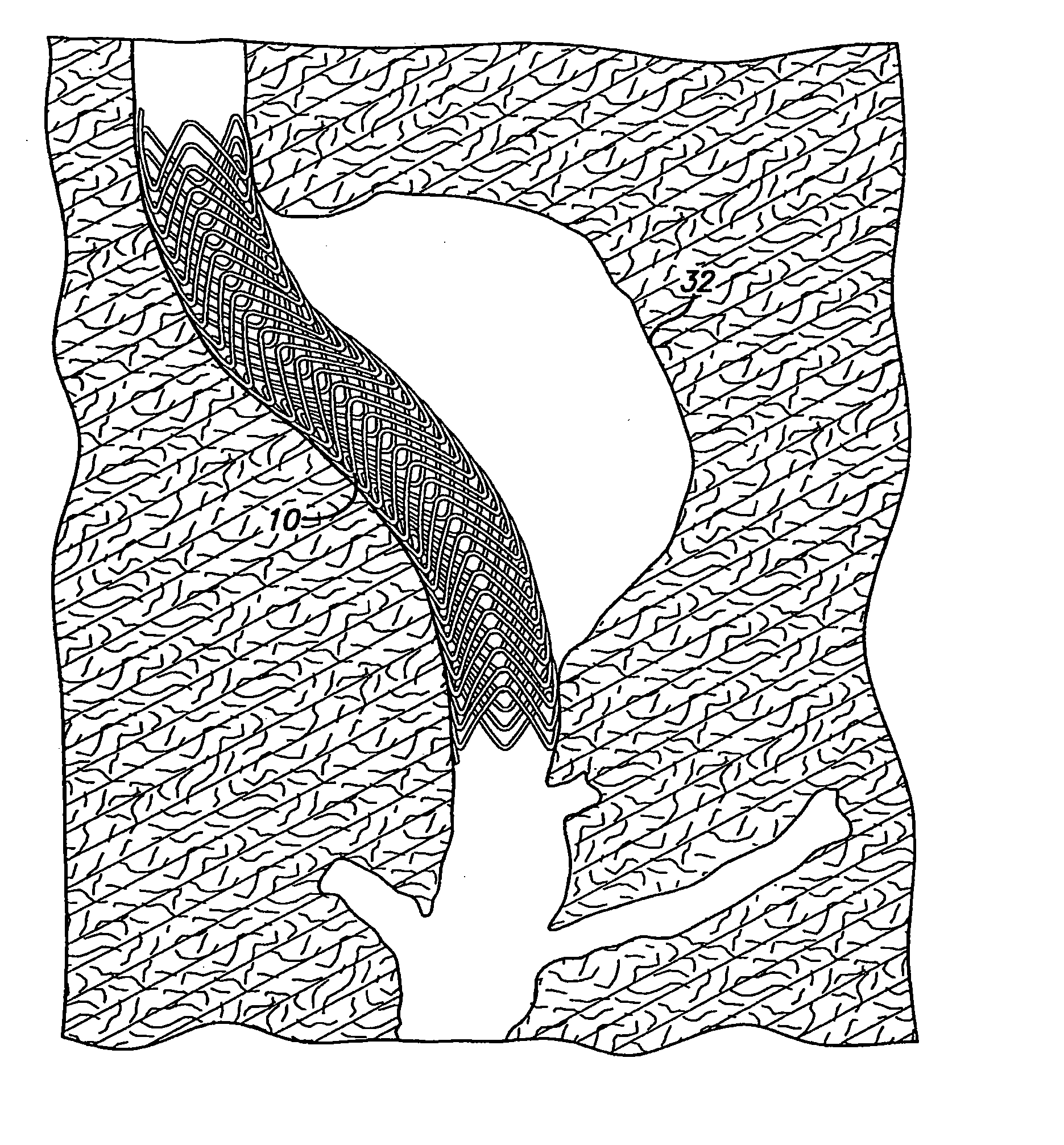 Intravascular Flow Modifier And Reinforcement Device And Deployment System For Same