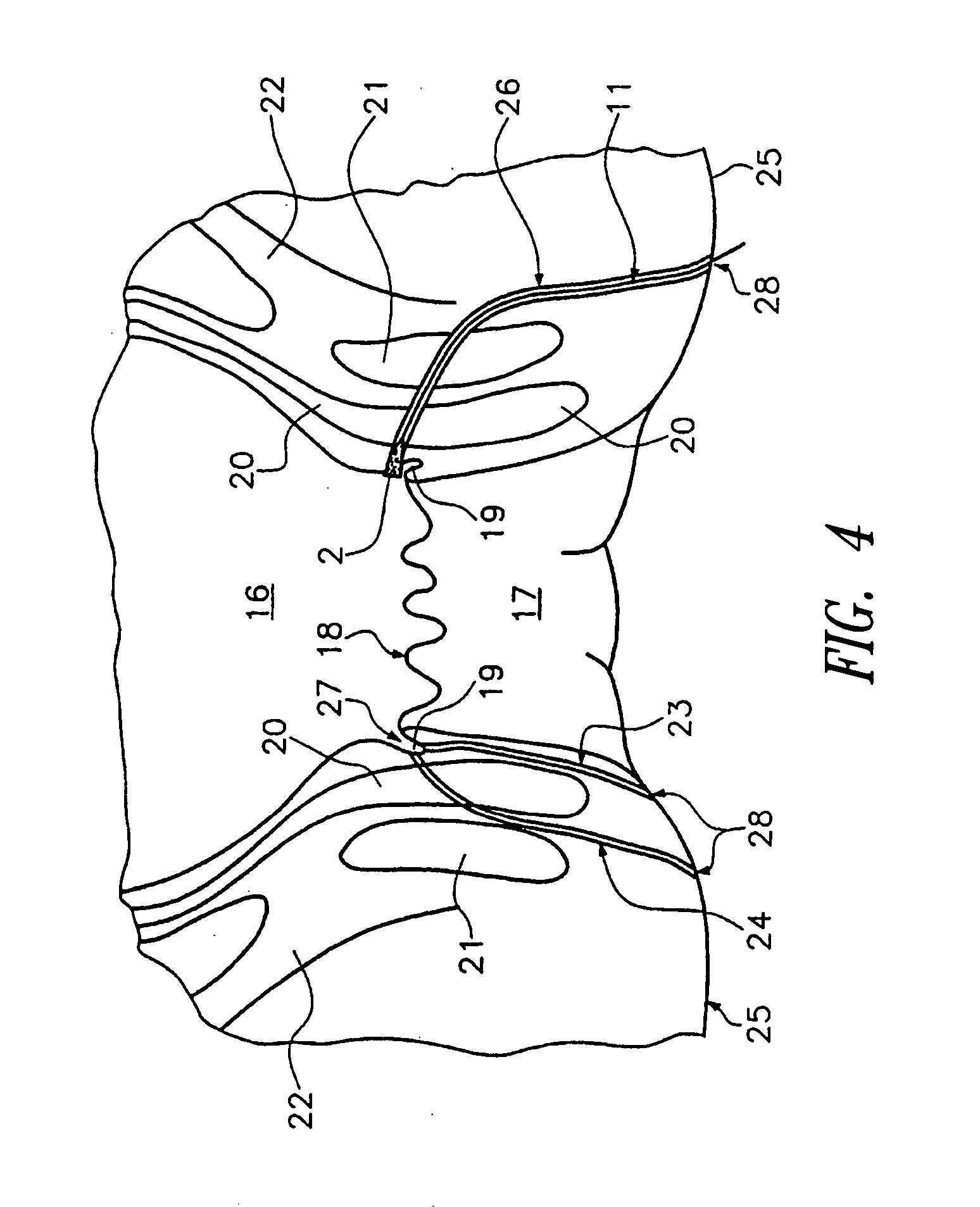 Fistula blocker