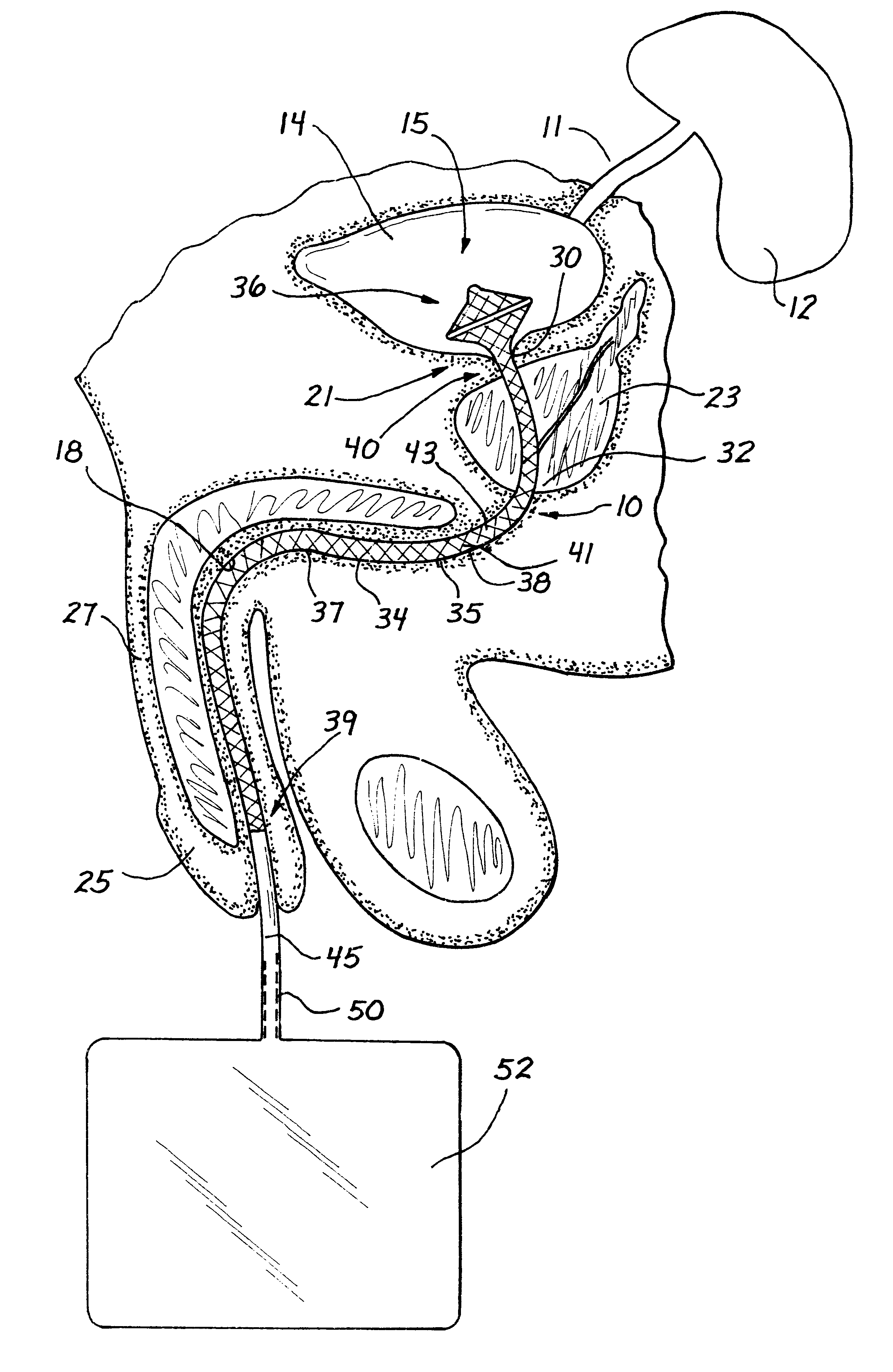 Drainage catheter