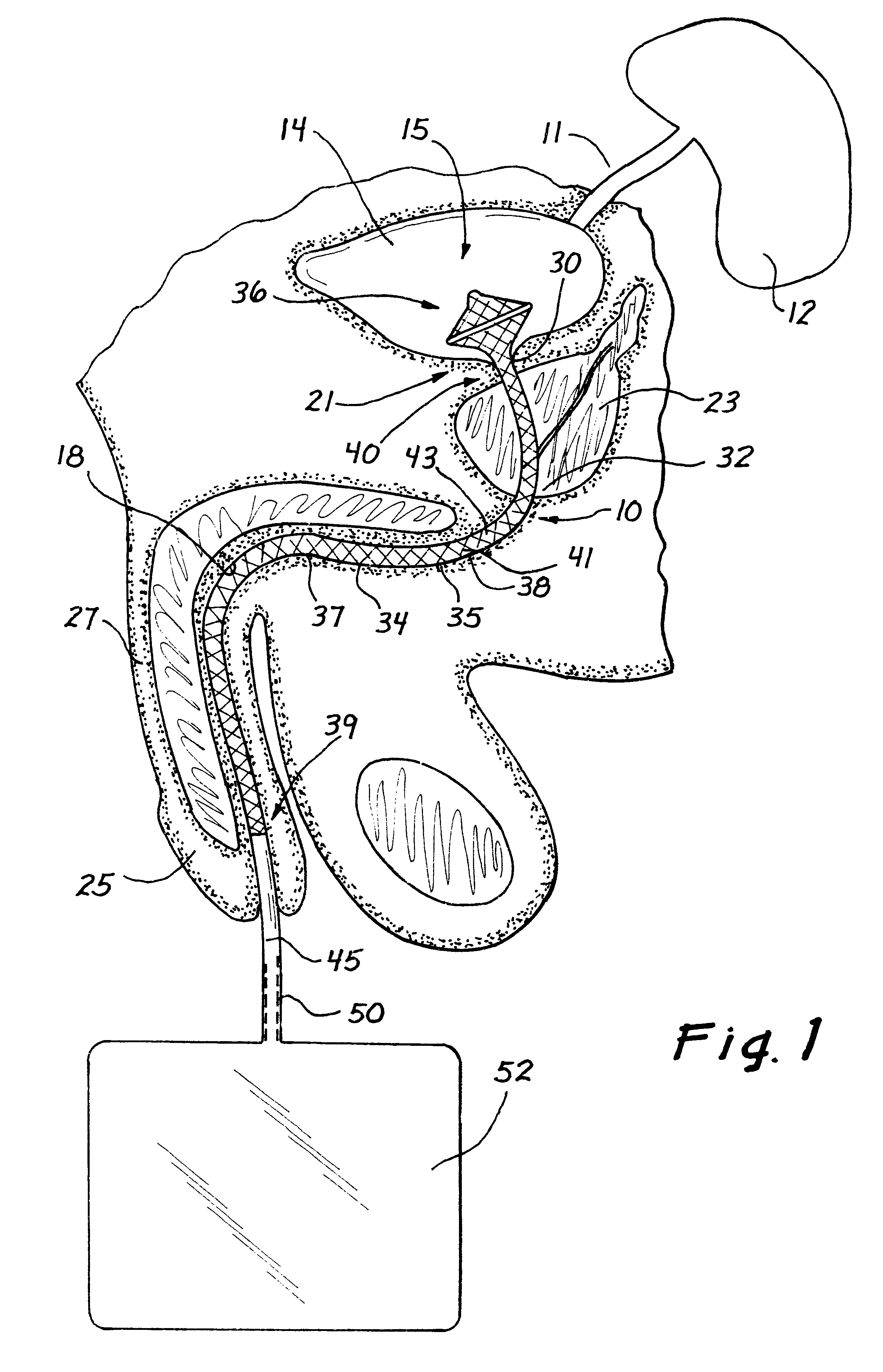 Drainage catheter